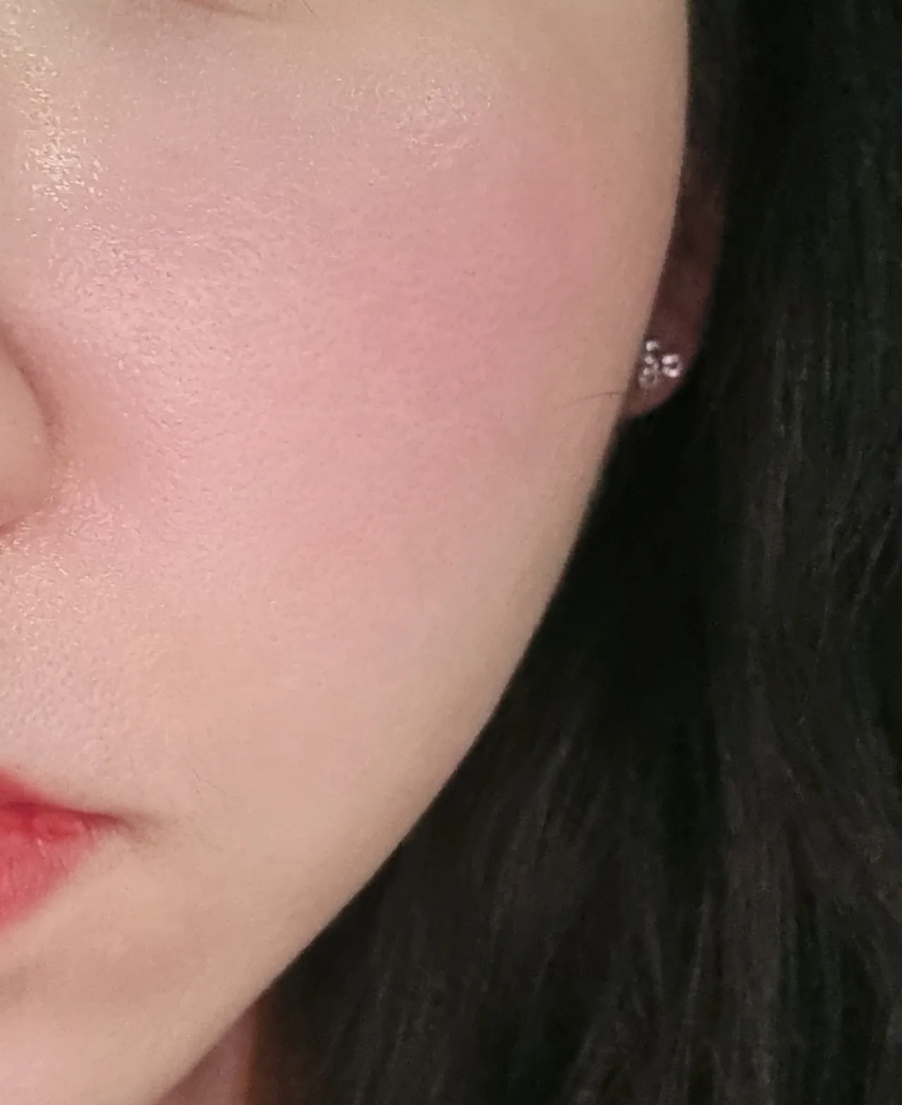시술 후 — 인모드 리프팅
