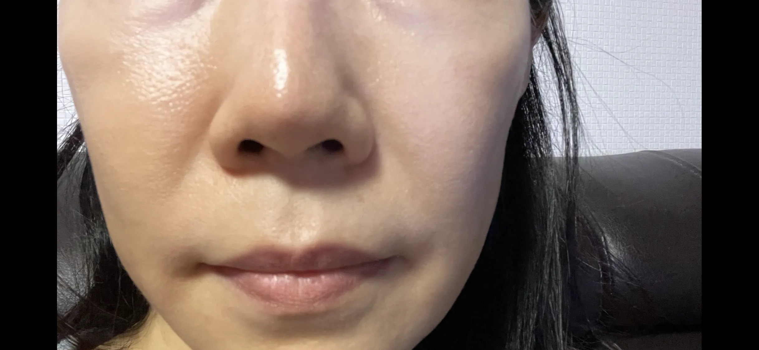 시술 전 사진