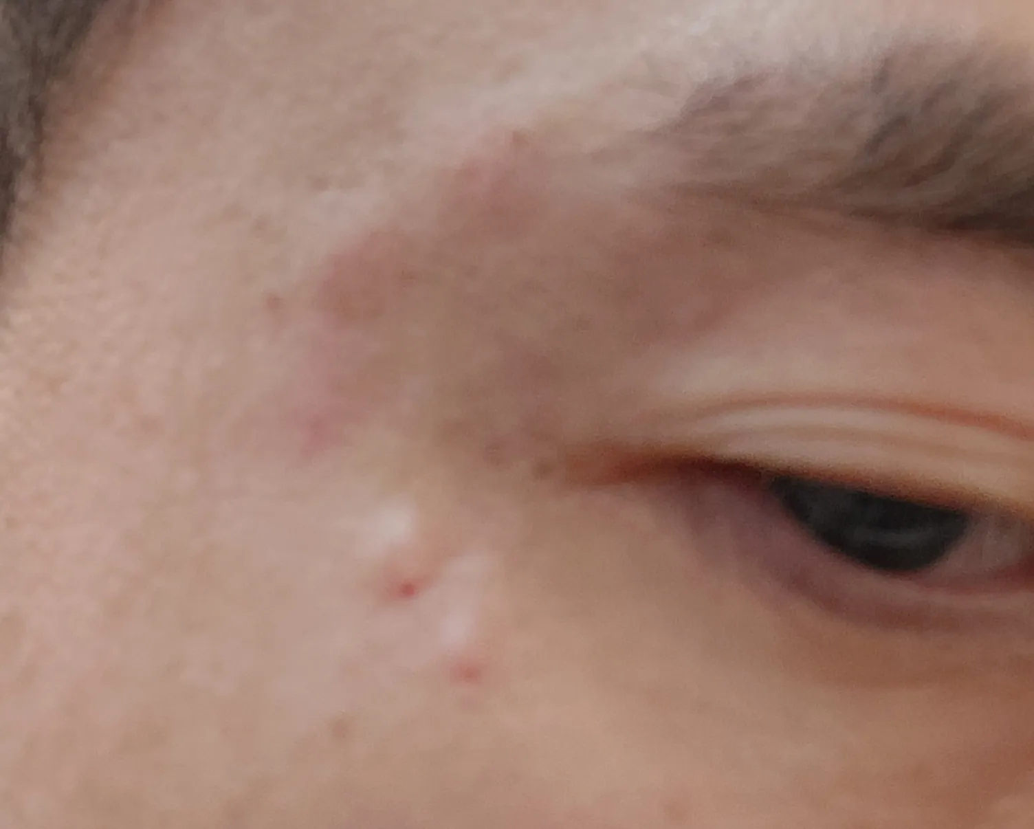 시술 후 — [앵콜]강남점_주름 보톡스 4900원