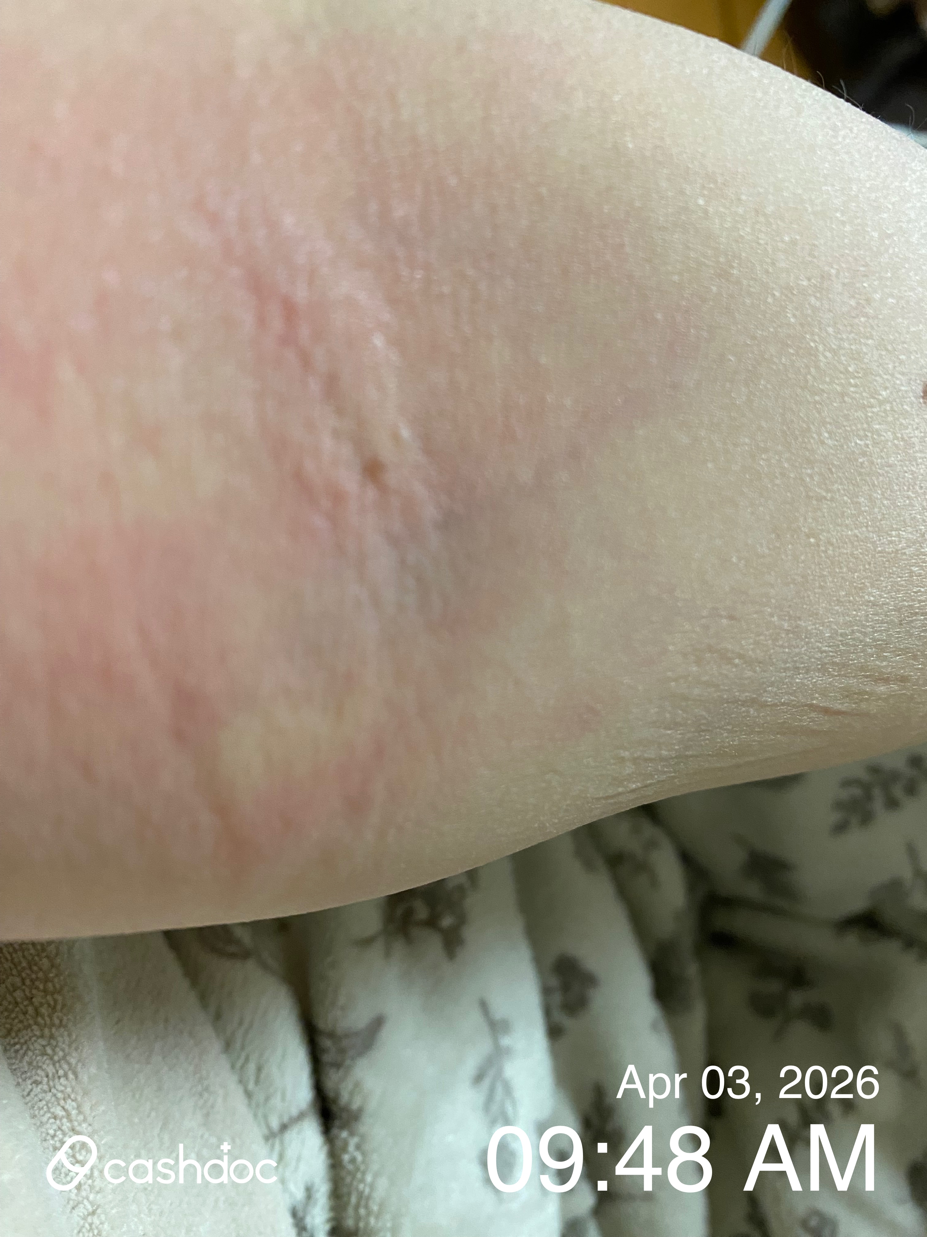 속초시 하얀나라피부과에서 빠르고 친절한 발진 치료 경험