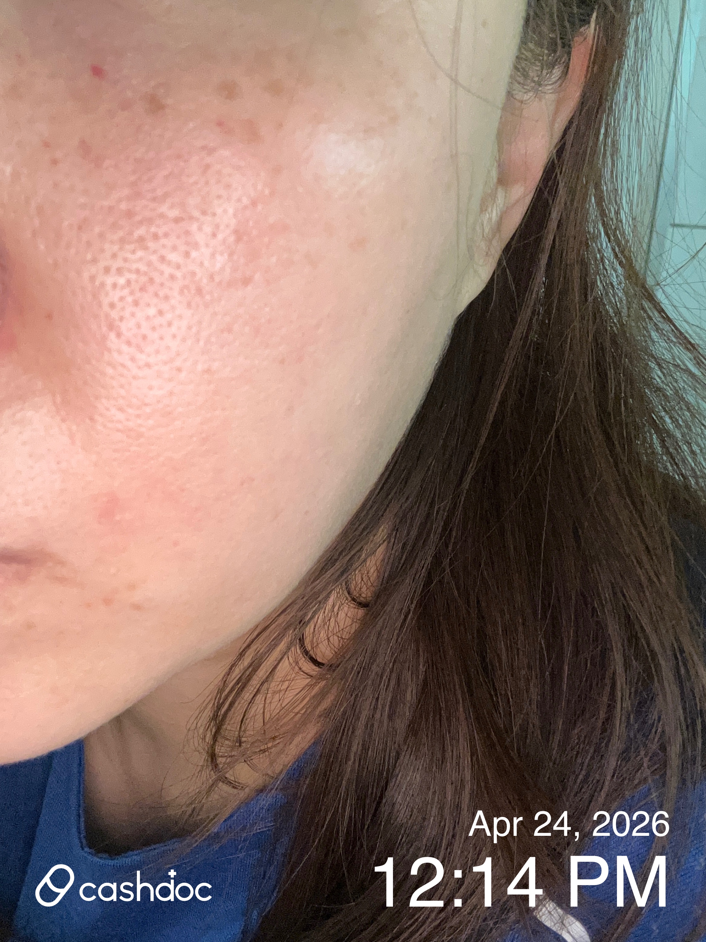 성남 메이퓨어의원, 피코토닝과 멜라듀스 시술 만족 후기