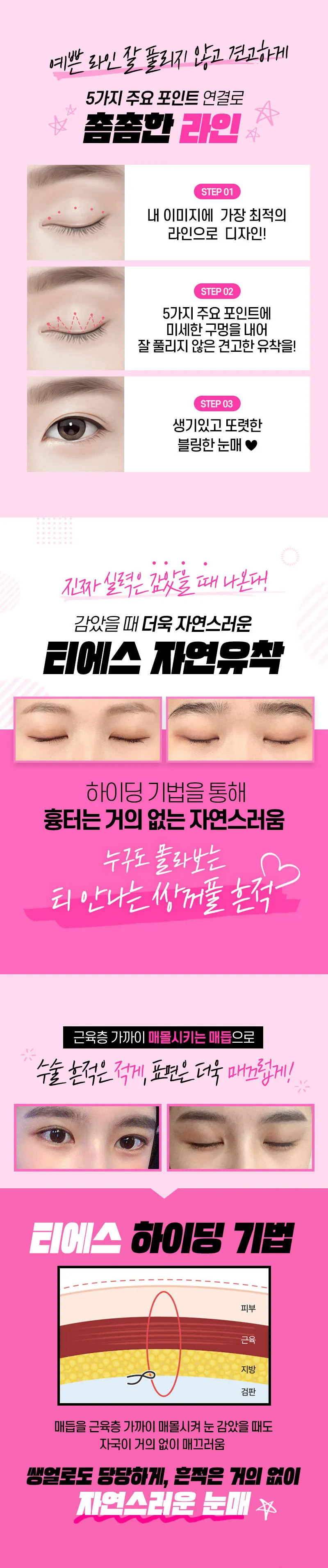 티에스성형외과 티에스 첫눈 3컨셉 자연유착 이벤트, 시술 상세 이미지