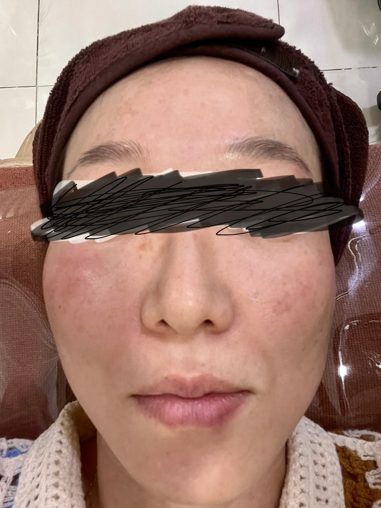 시술 전 — 미케이 피부색소 지우개