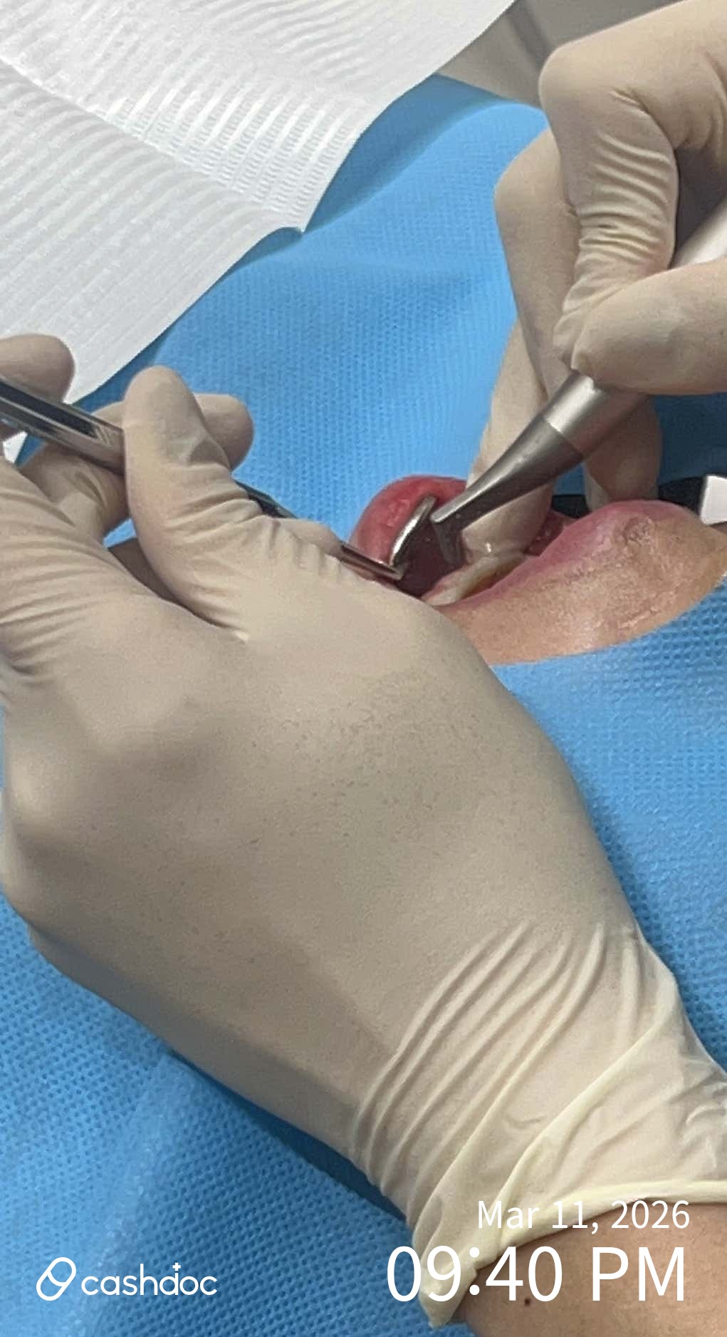 강서구 연세고마운치과에서 치아미백 효과에 감동!