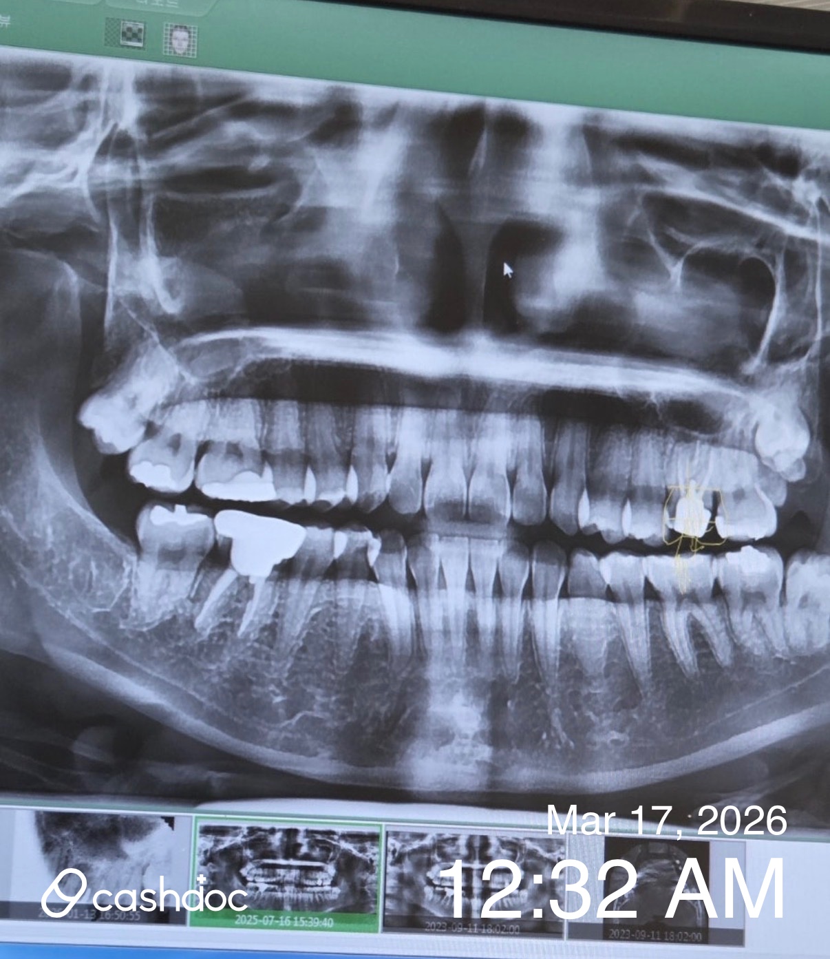 서울수치과의원, 일요일에도 치료 잘해주는 곳