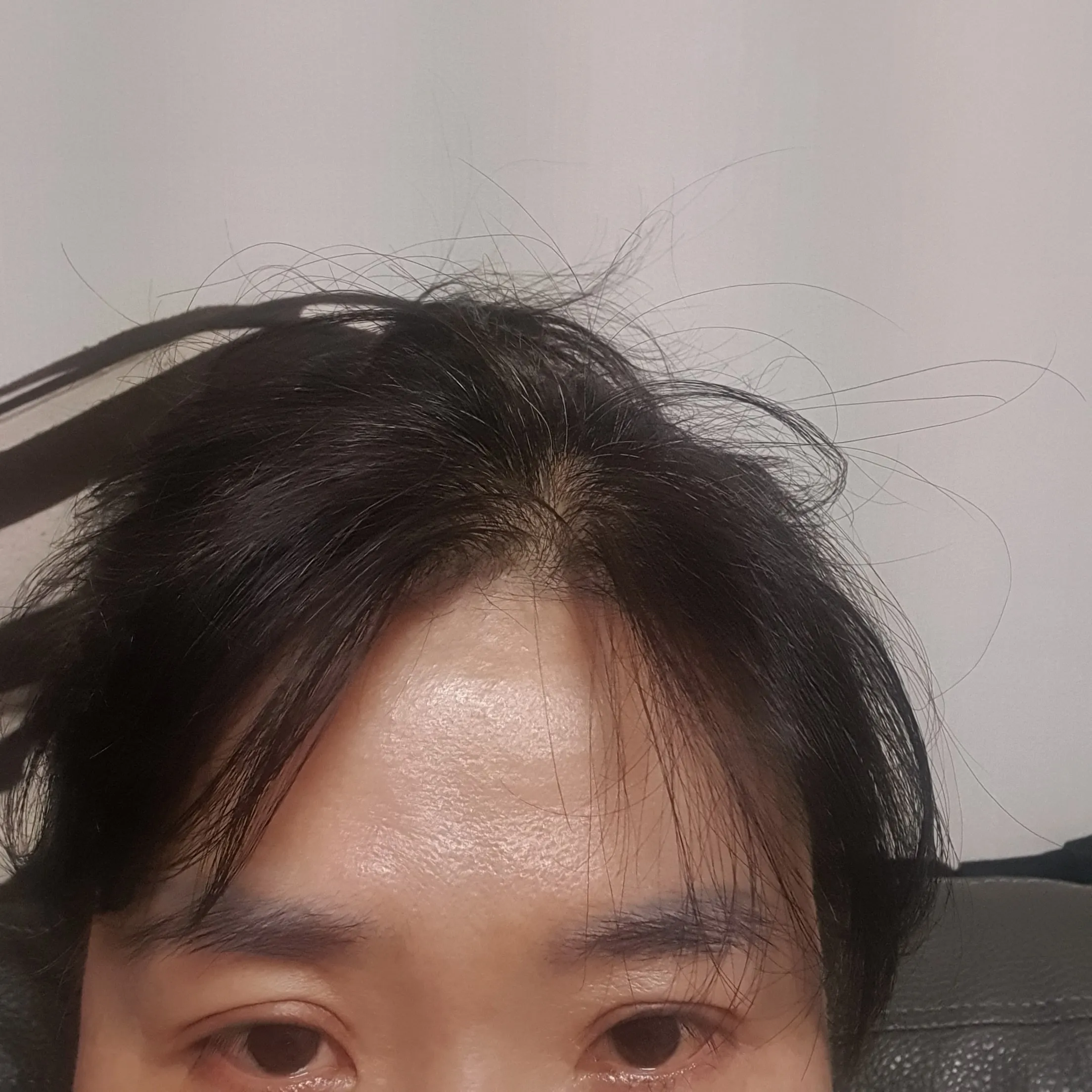 시술 후 — 강남점_주름 보톡스 4,900원