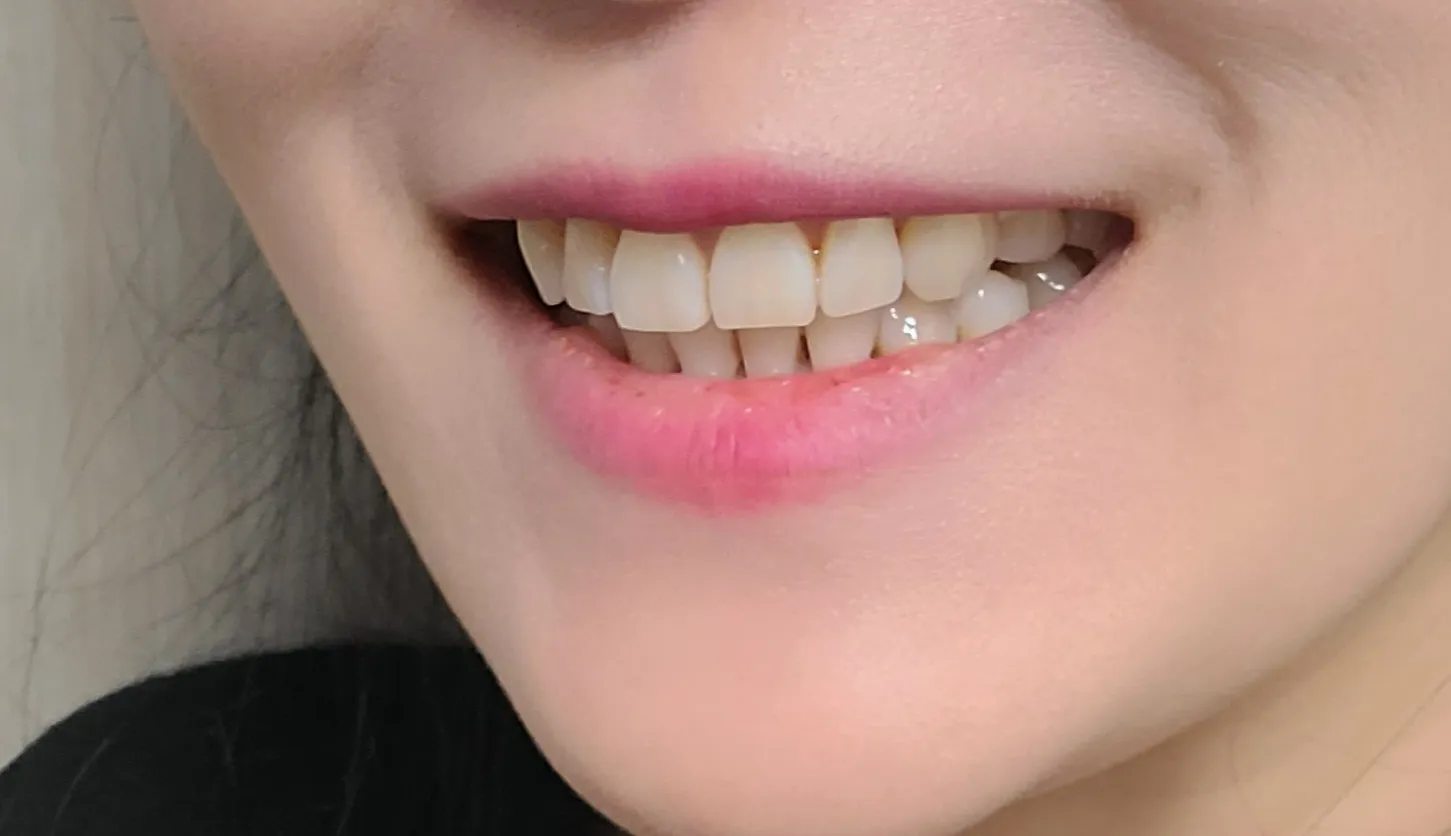 After treatment — Teeth Whitening in 30 Minutes