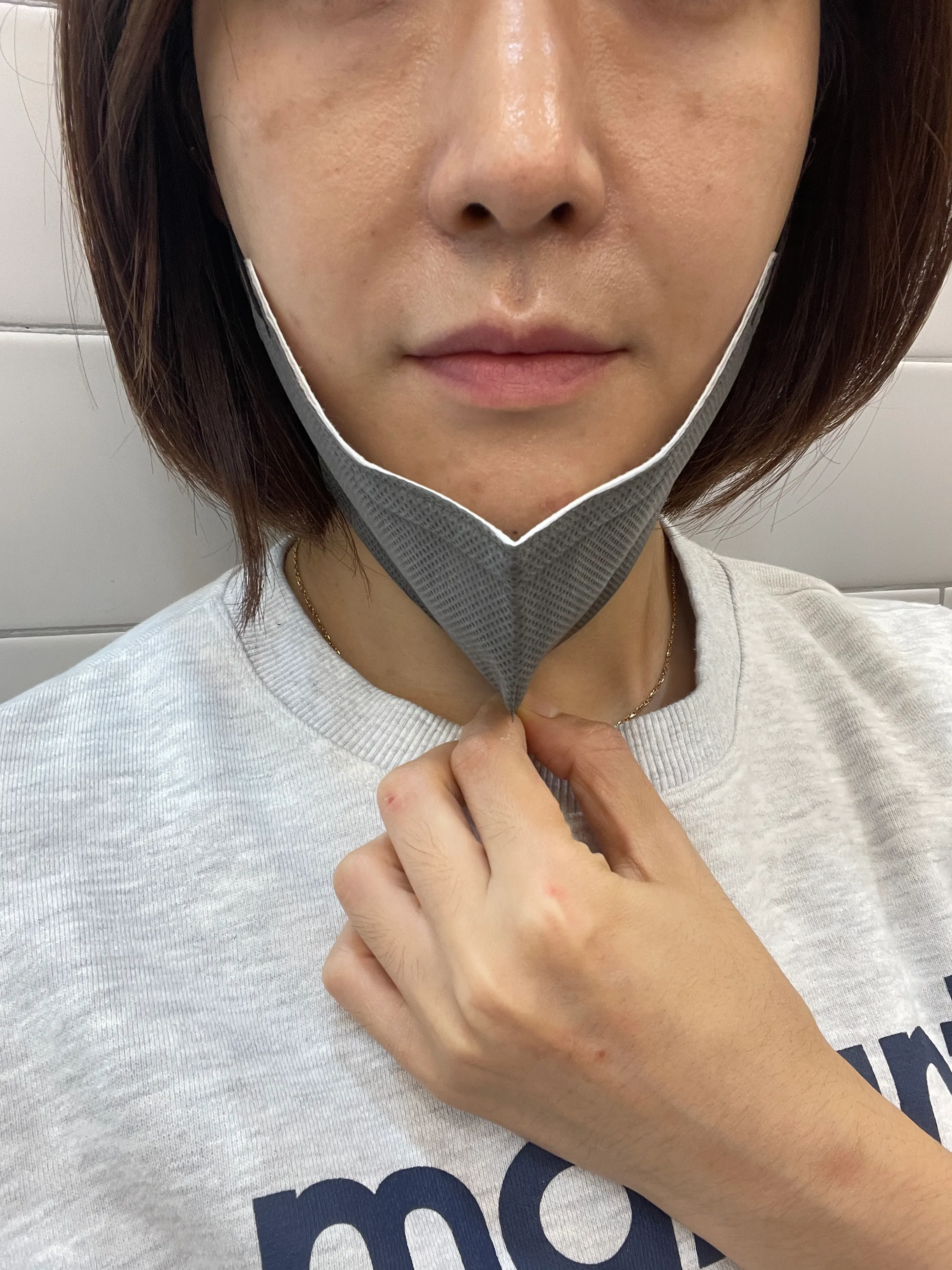 시술 전 — 기미/색소 완벽파괴! #대세 피코토닝