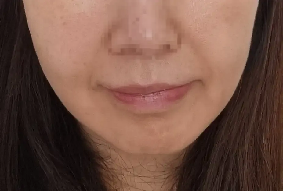 术前照片
