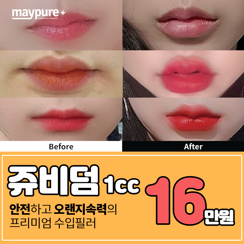 가장 유명한 수입필러 #쥬비덤 이벤트 썸네일 이미지
