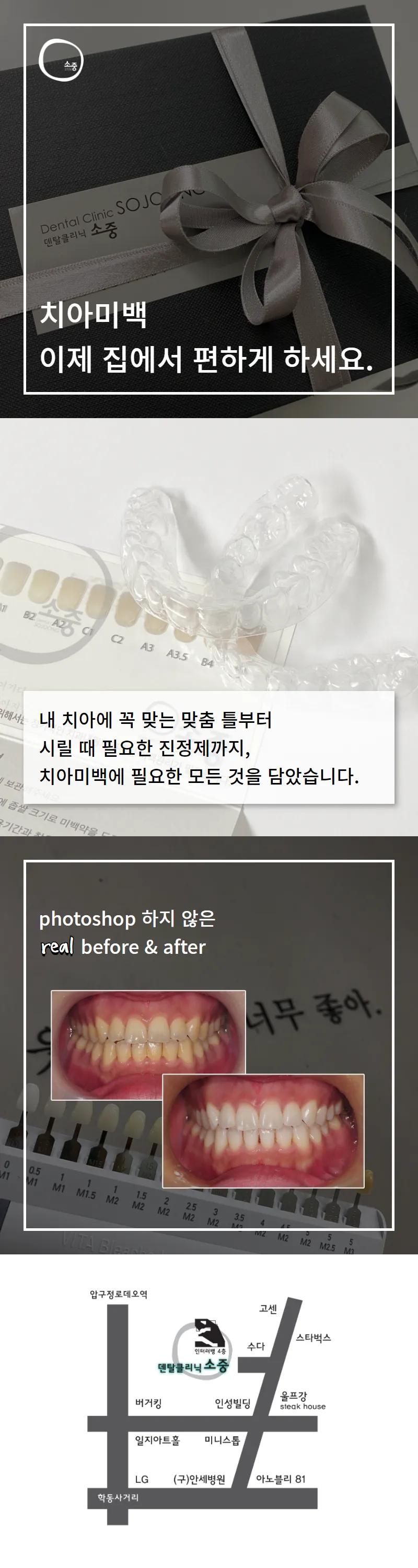 소중치과의원 집에서 편하게 하는 치아미백 이벤트, 시술 상세 이미지