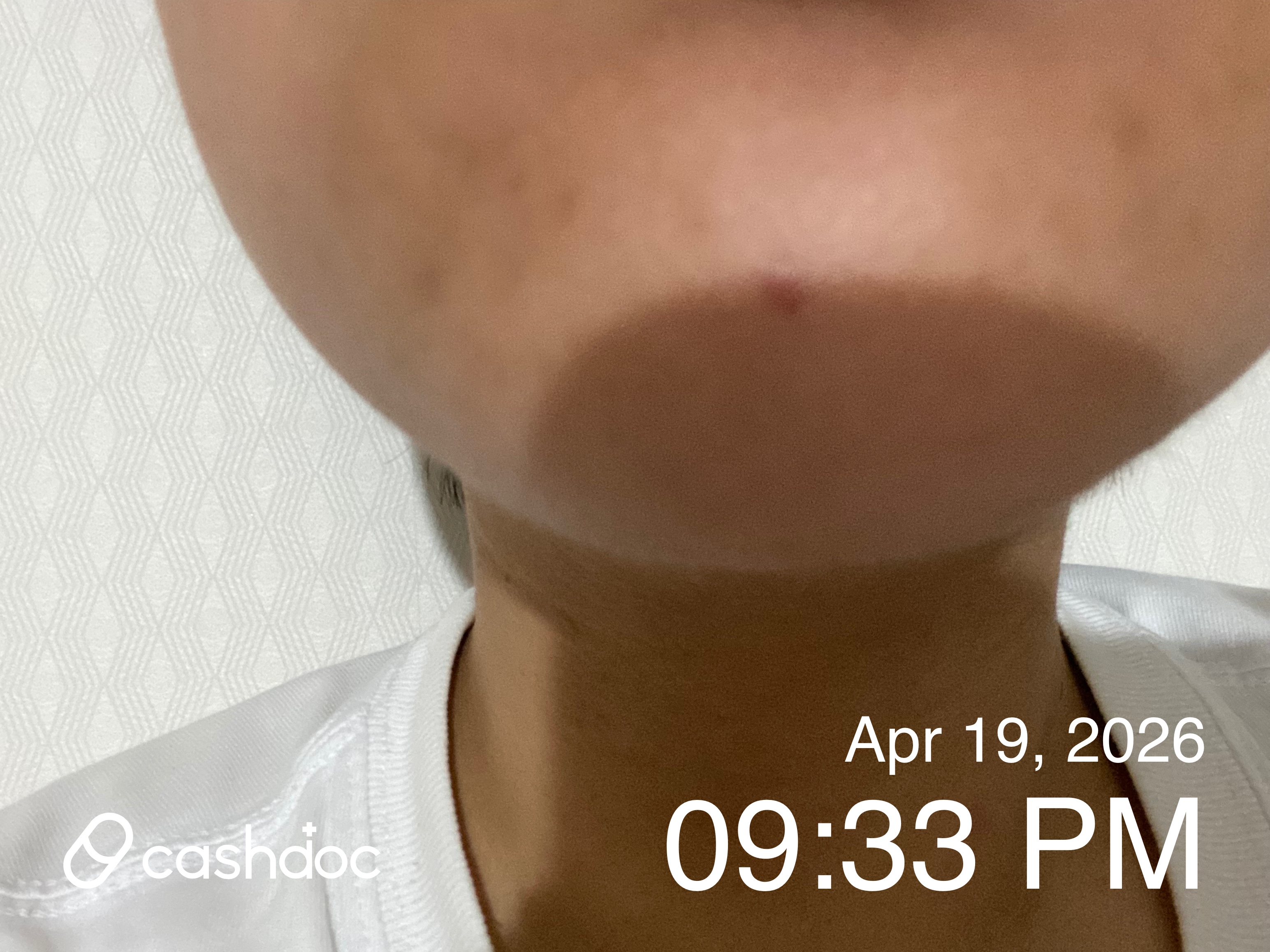 원주스노우의원에서 점 빼기, 통증 적고 결과 만족스러워요