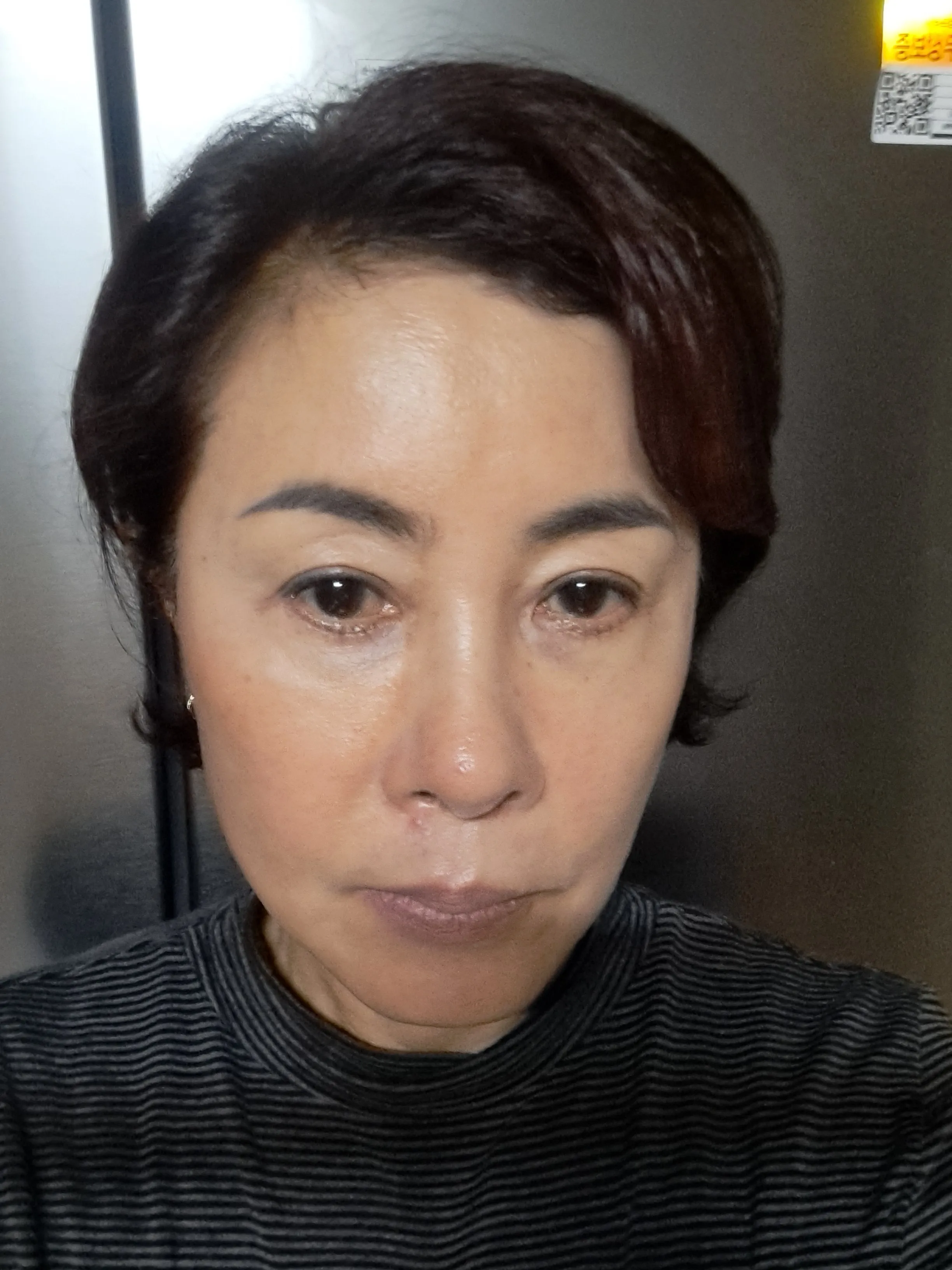 시술 전 — [잡티지우개]에이톤레이저