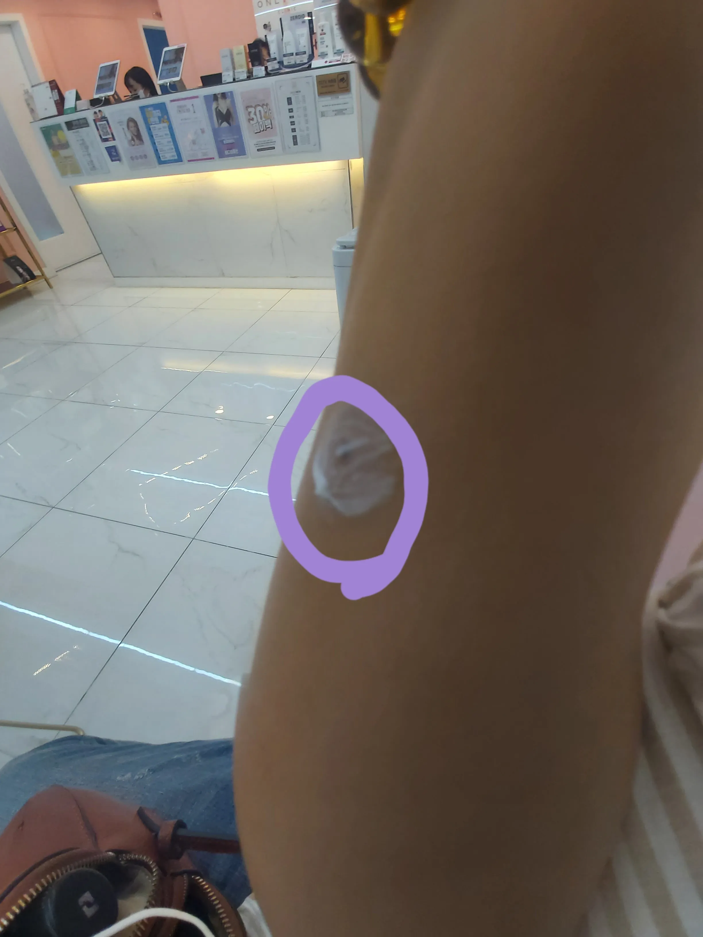 시술 전 — 얼굴 점제거