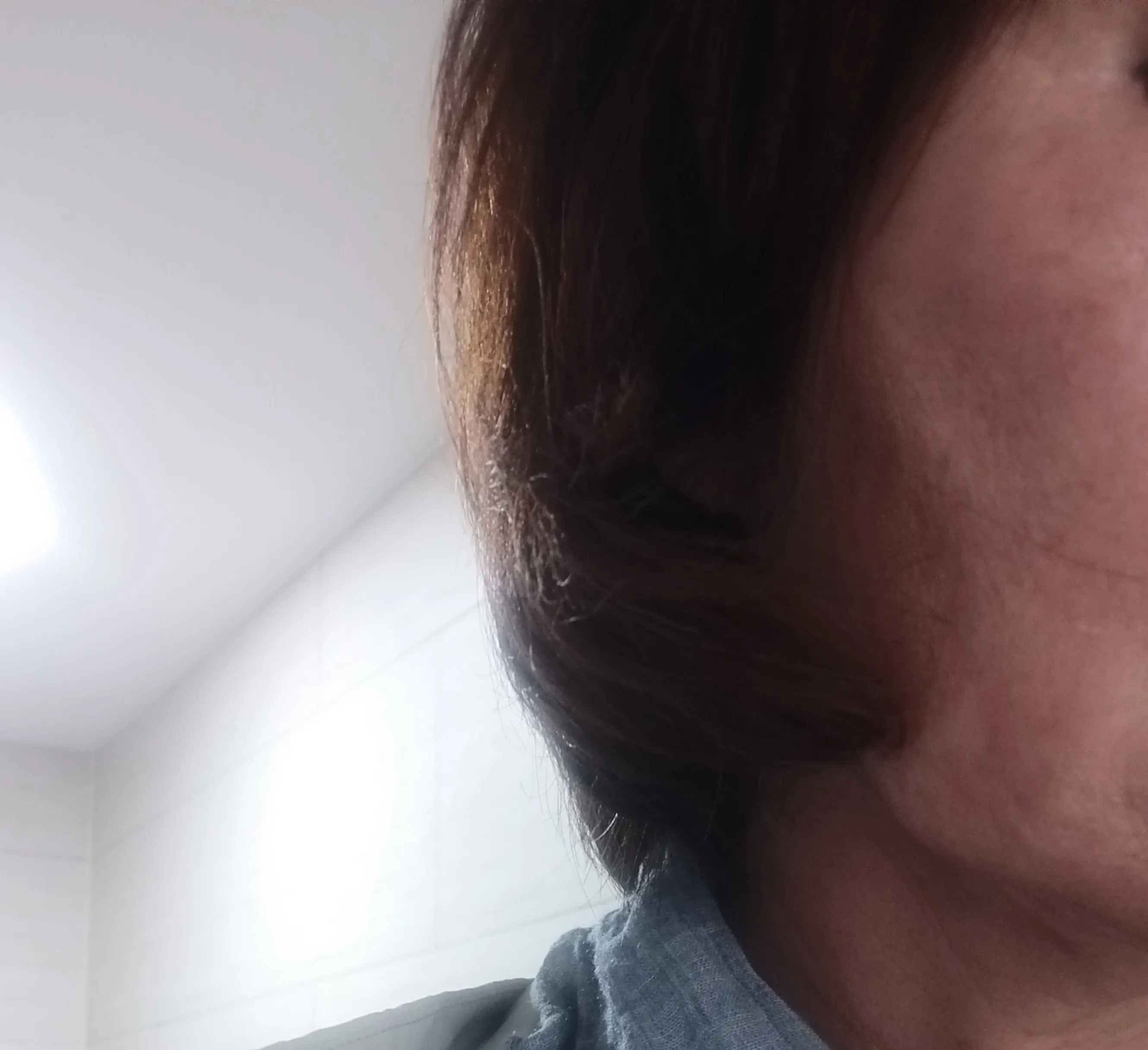 Before treatment — Skin Regeneration #Skin Elasticity #For Fine Lines: Rejuran Healer