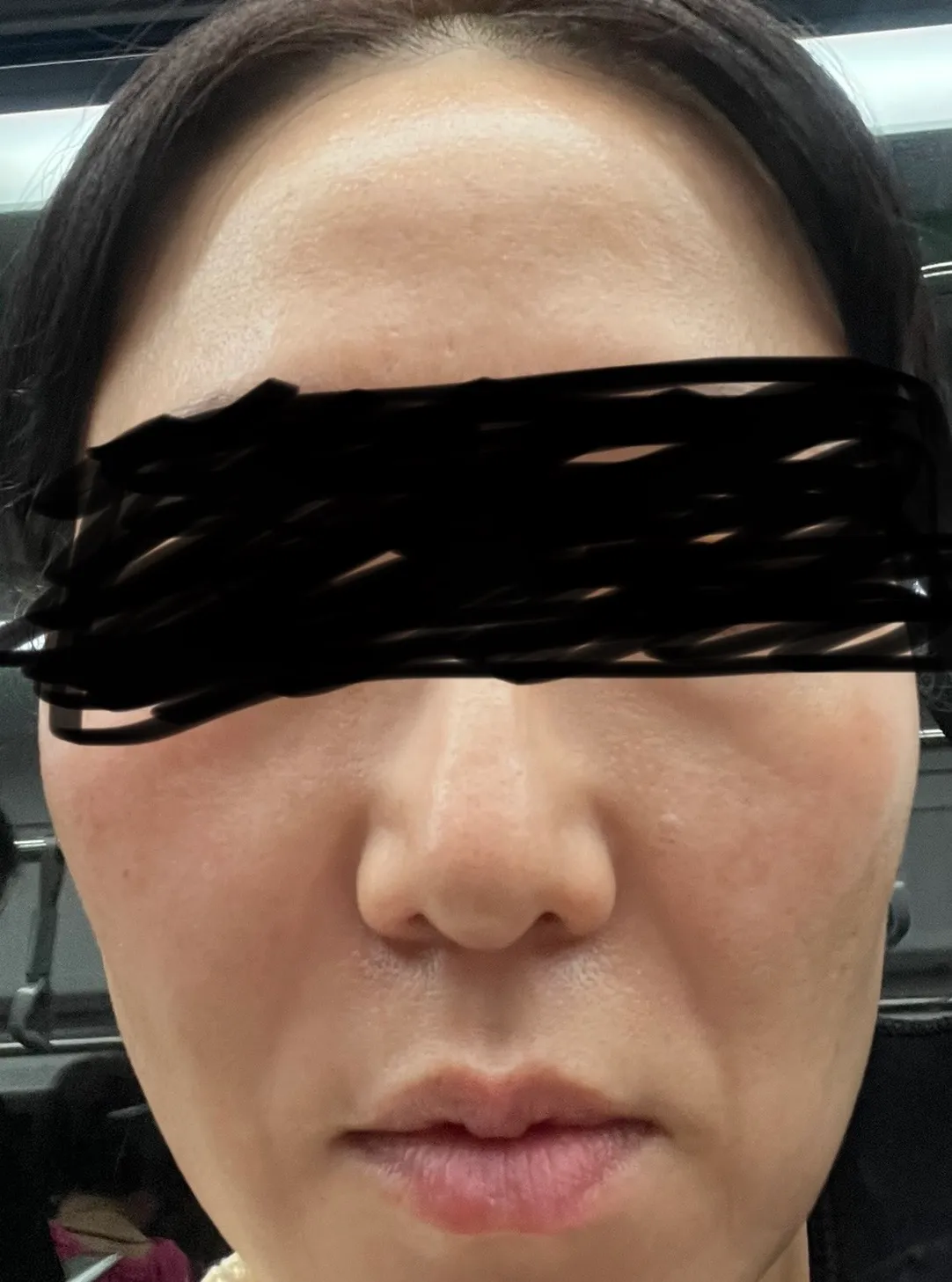 시술 후 — 미케이 피부색소 지우개