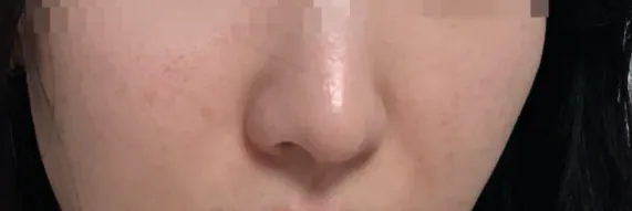시술 후 — 명품스킨부스터 #NCTF주사 