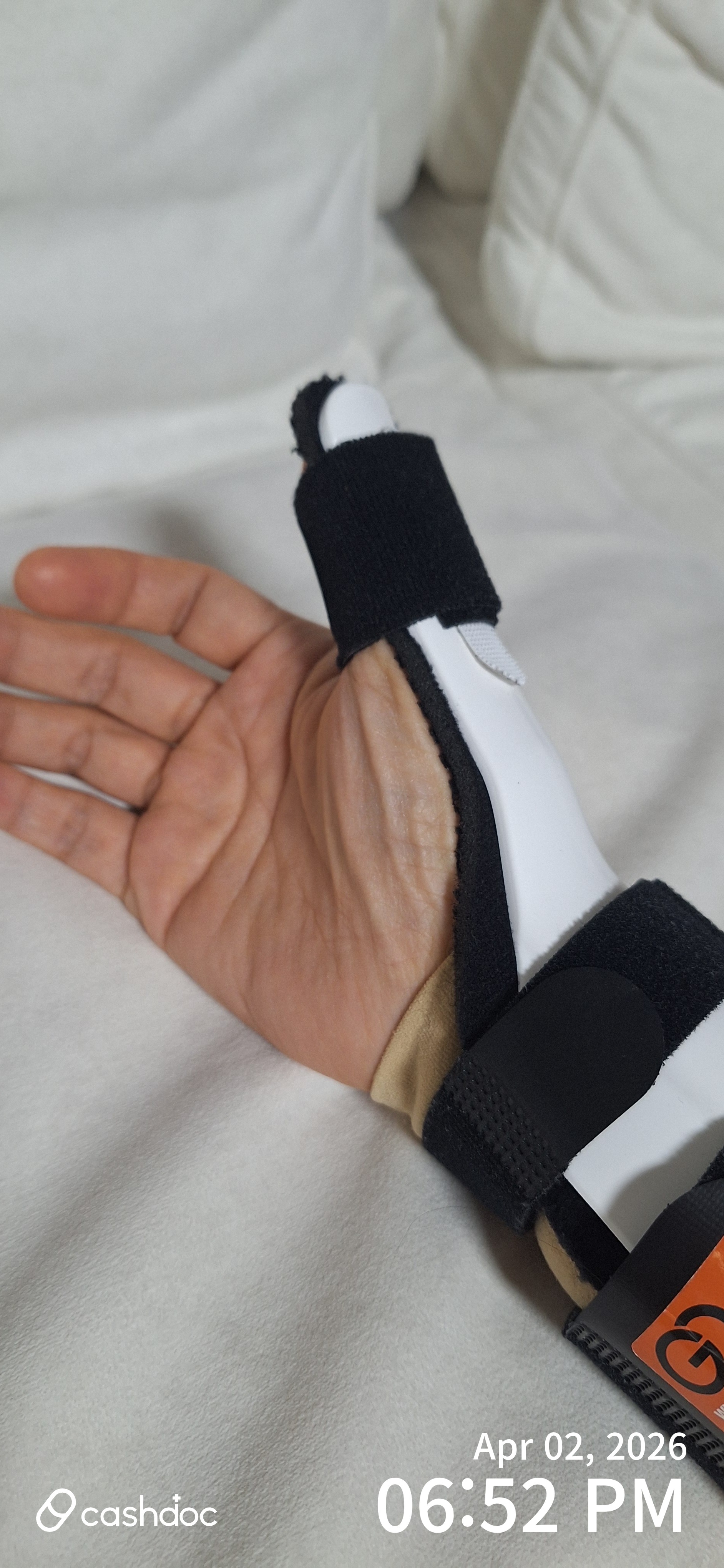 김해시 신성정형외과의원, 엄지손가락 통증 치료 후기