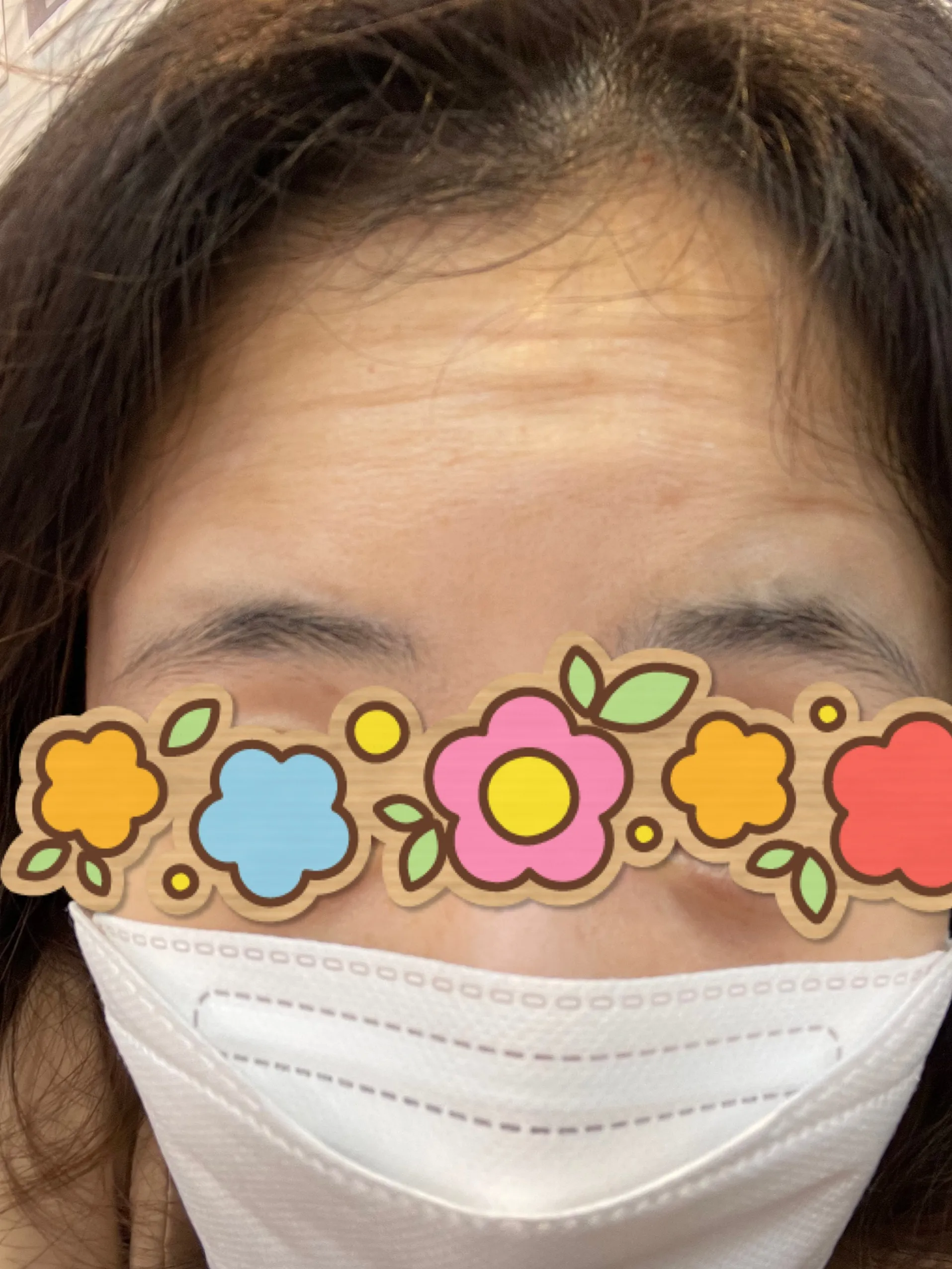 시술 전 — [앵콜]강남점_주름 보톡스 4900원