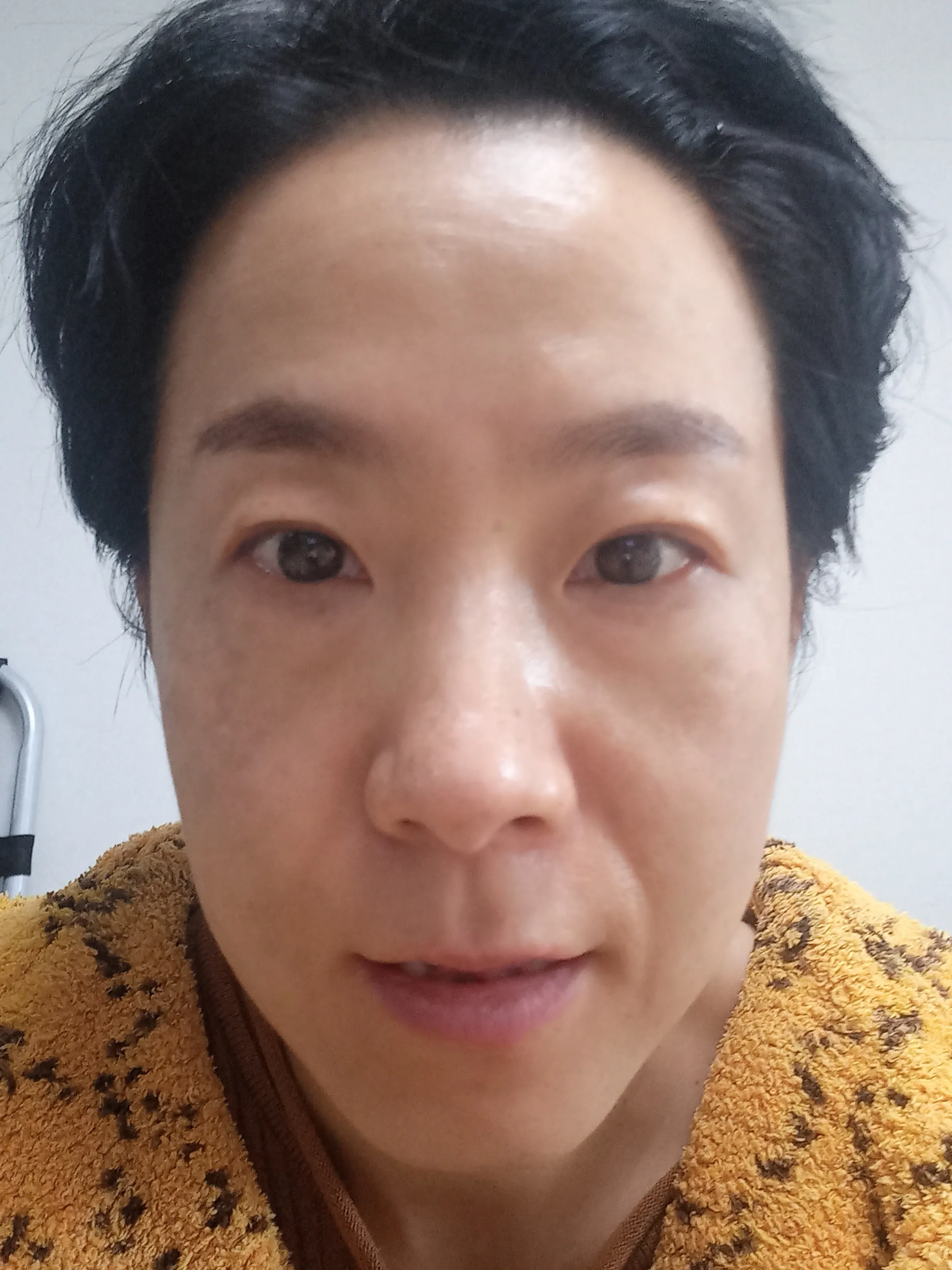시술 전 — 미케이 피부색소 지우개