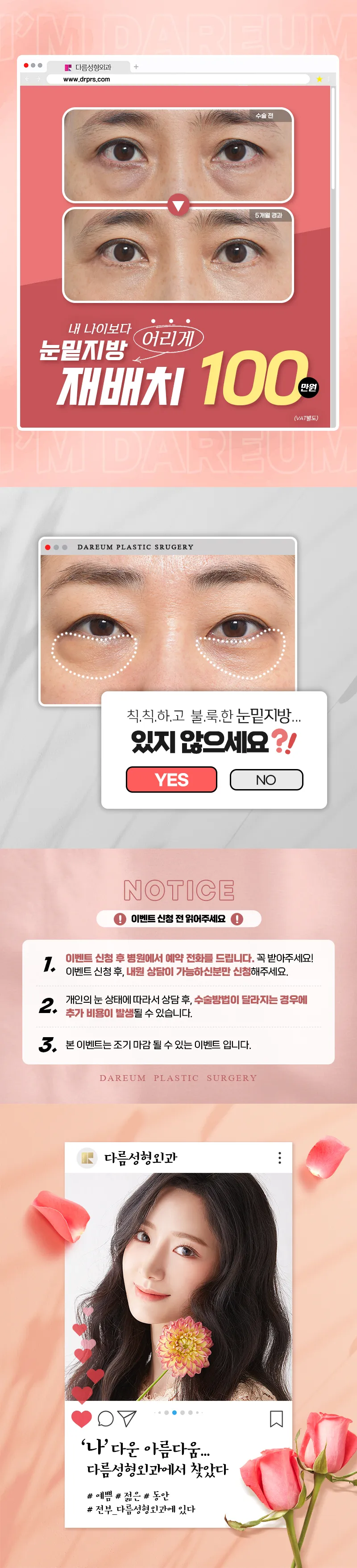 다름성형외과 어두운 눈밑은? 다름 눈밑지방재배치 이벤트, 시술 상세 이미지