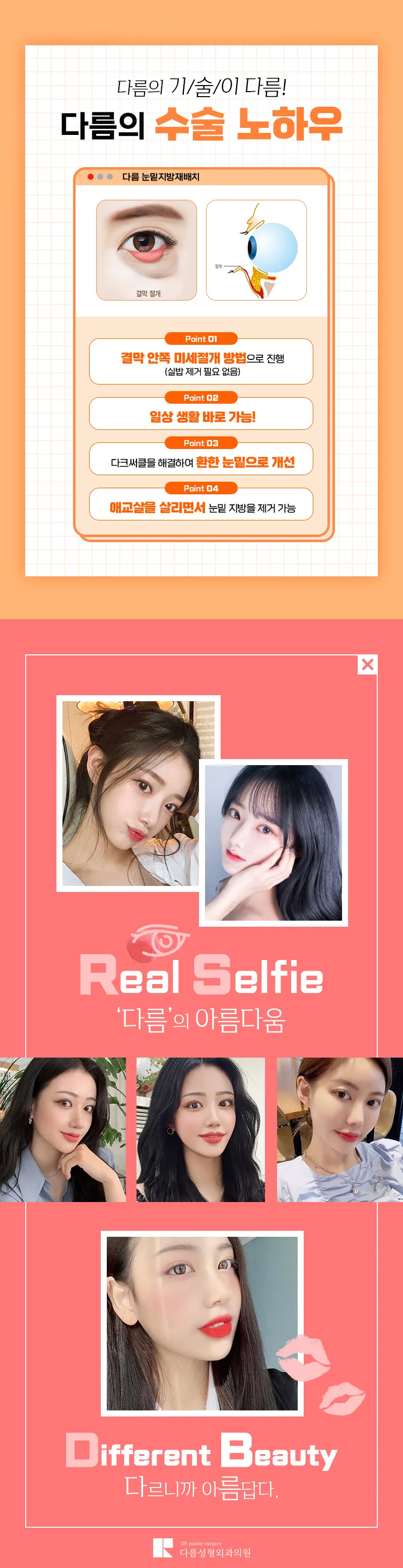 다름성형외과 어두운 눈밑은? 다름 눈밑지방재배치 이벤트, 시술 상세 이미지