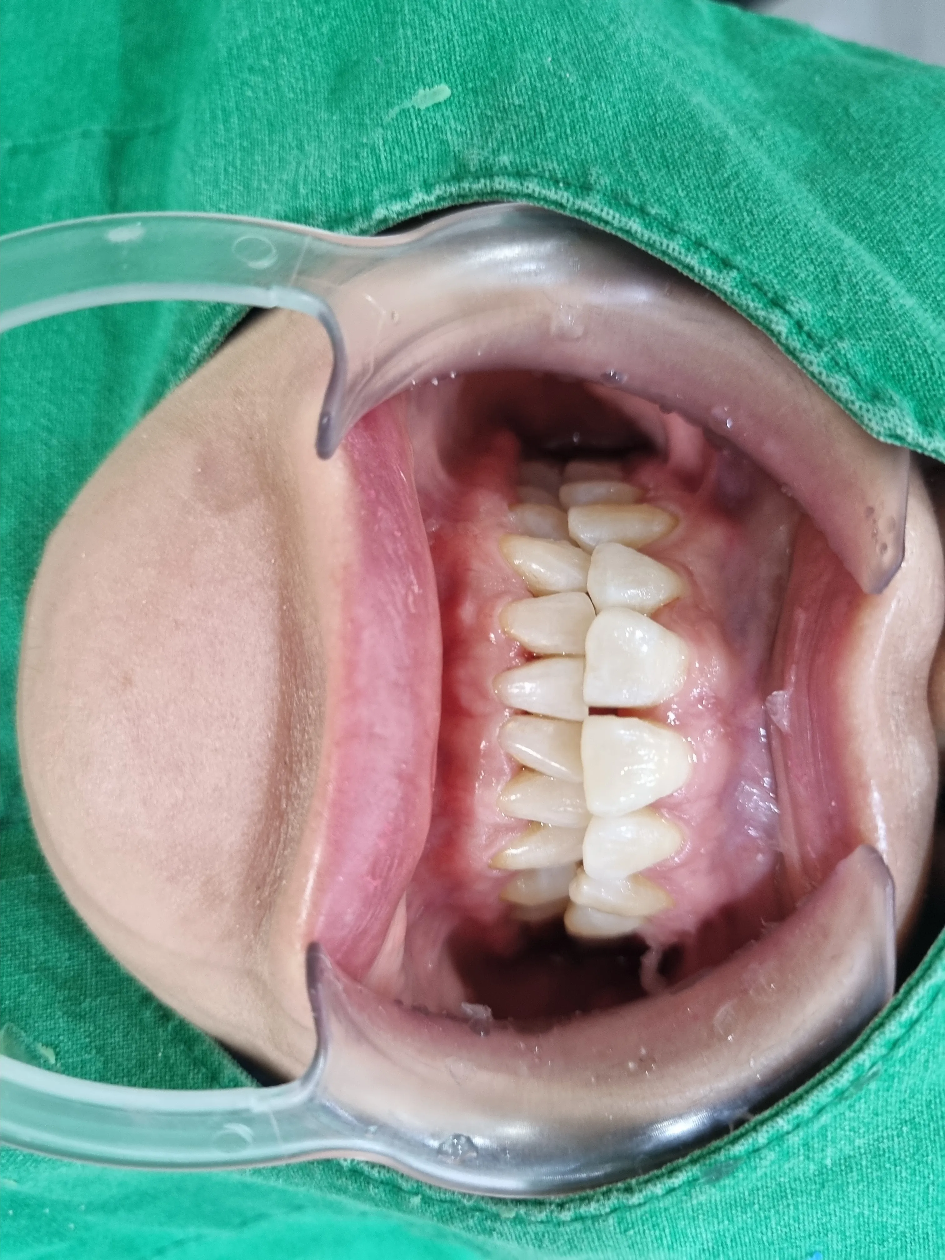 After treatment — 30-Minute Complete Teeth Whitening Program