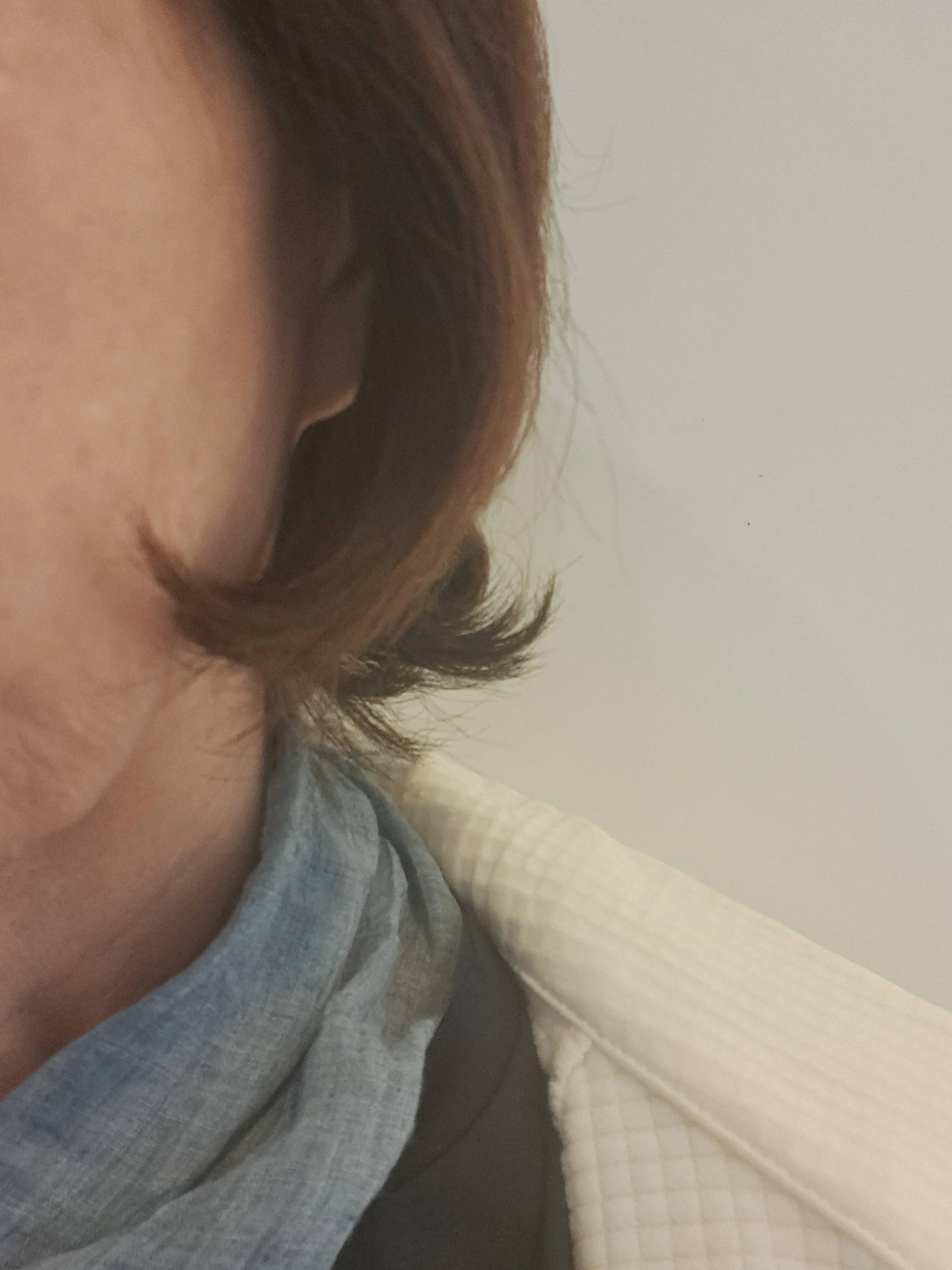 After treatment — Skin Regeneration #Skin Elasticity #For Fine Lines: Rejuran Healer
