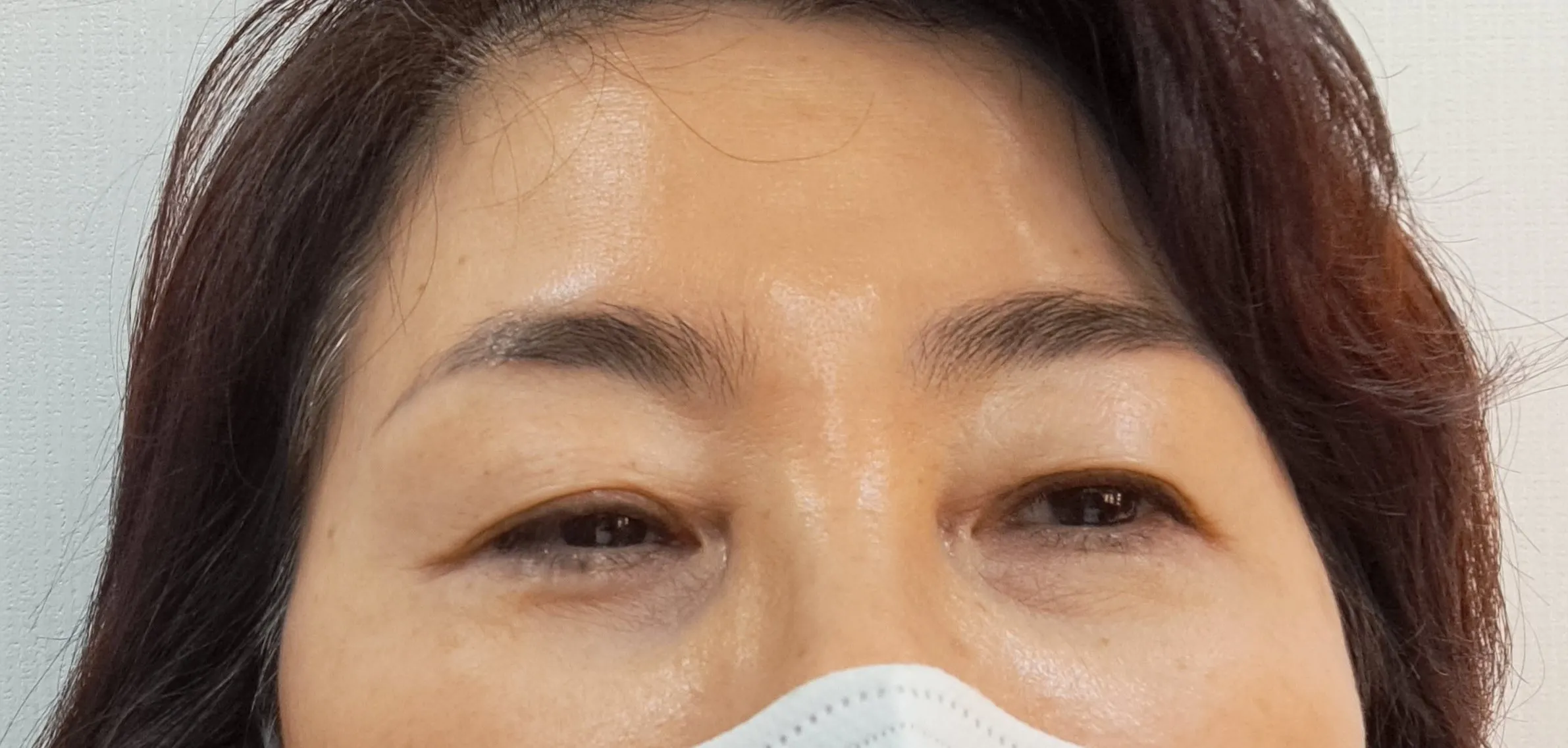 시술 전 — 	번지지않는 아이라인반영구	