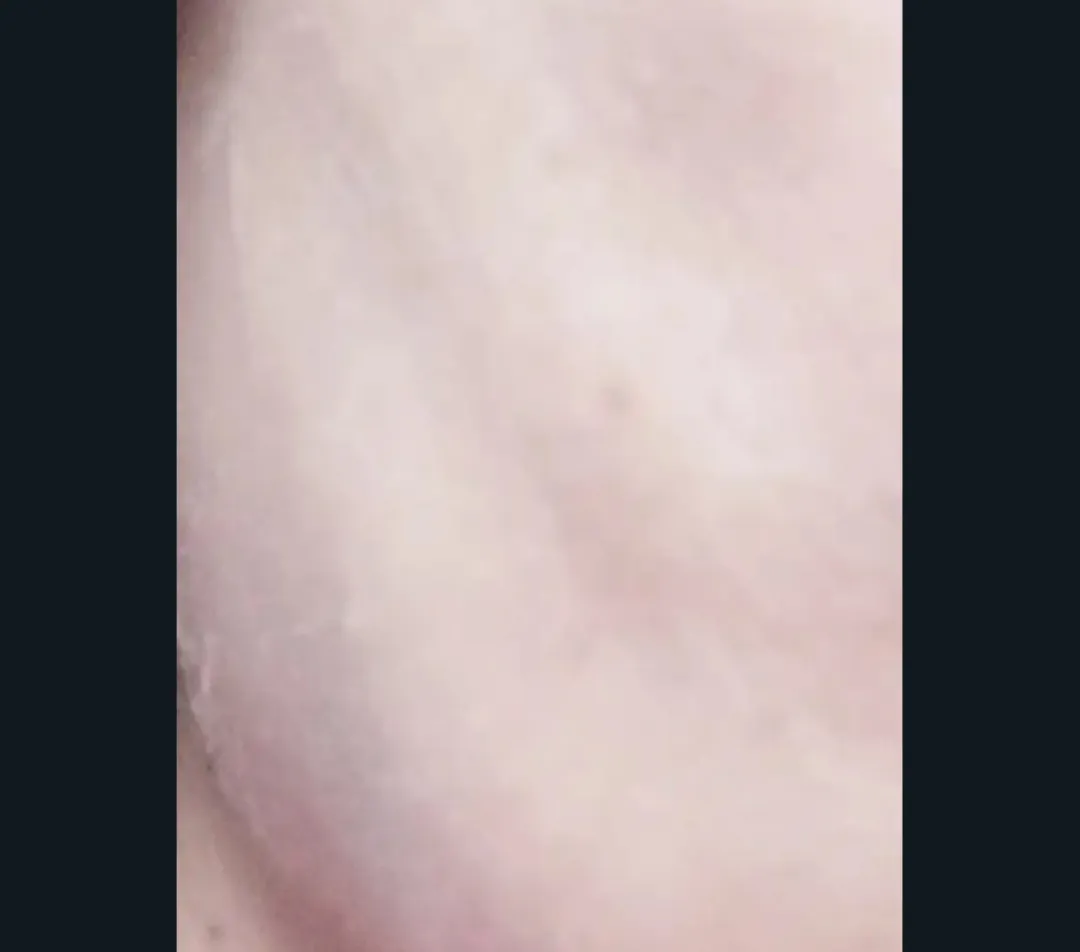시술 후 — 뉴스타 , 기미잡티제거 피코토닝