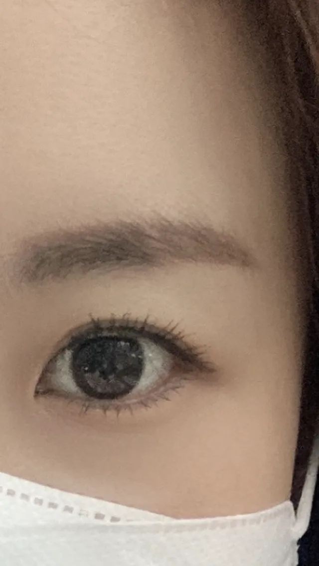 Before treatment — Lize Eye (Rejuran Eye + Eye Shrink) Package