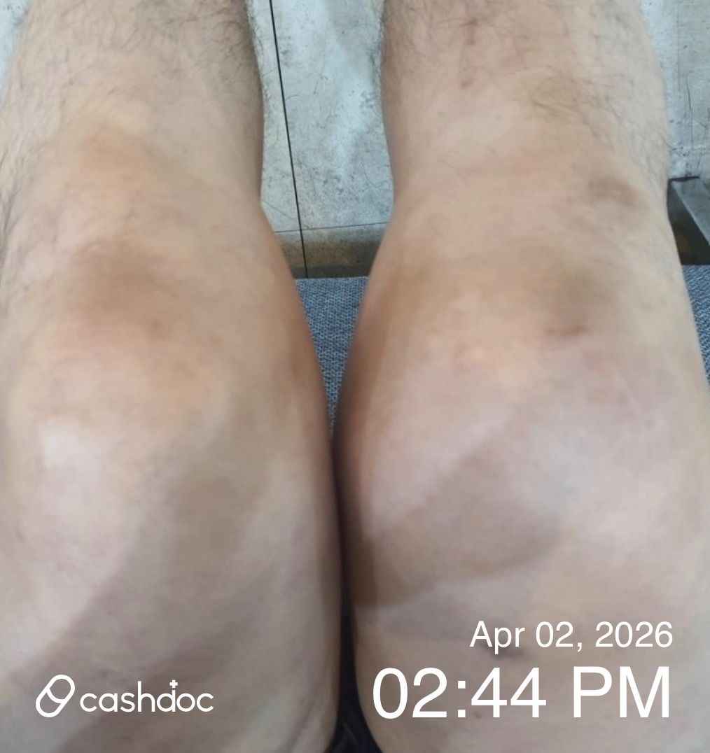 청주시 박남규내과의원에서 겨우 가라앉은 급성 통풍 통증