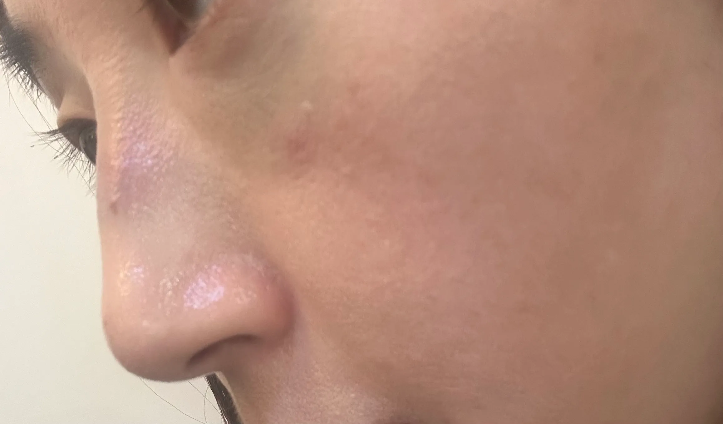 Before treatment — Skin Regeneration #Skin Elasticity #For Fine Lines: Rejuran Healer