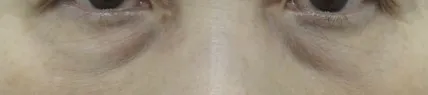 项目前 — 规划者❤中年下眼睑手术