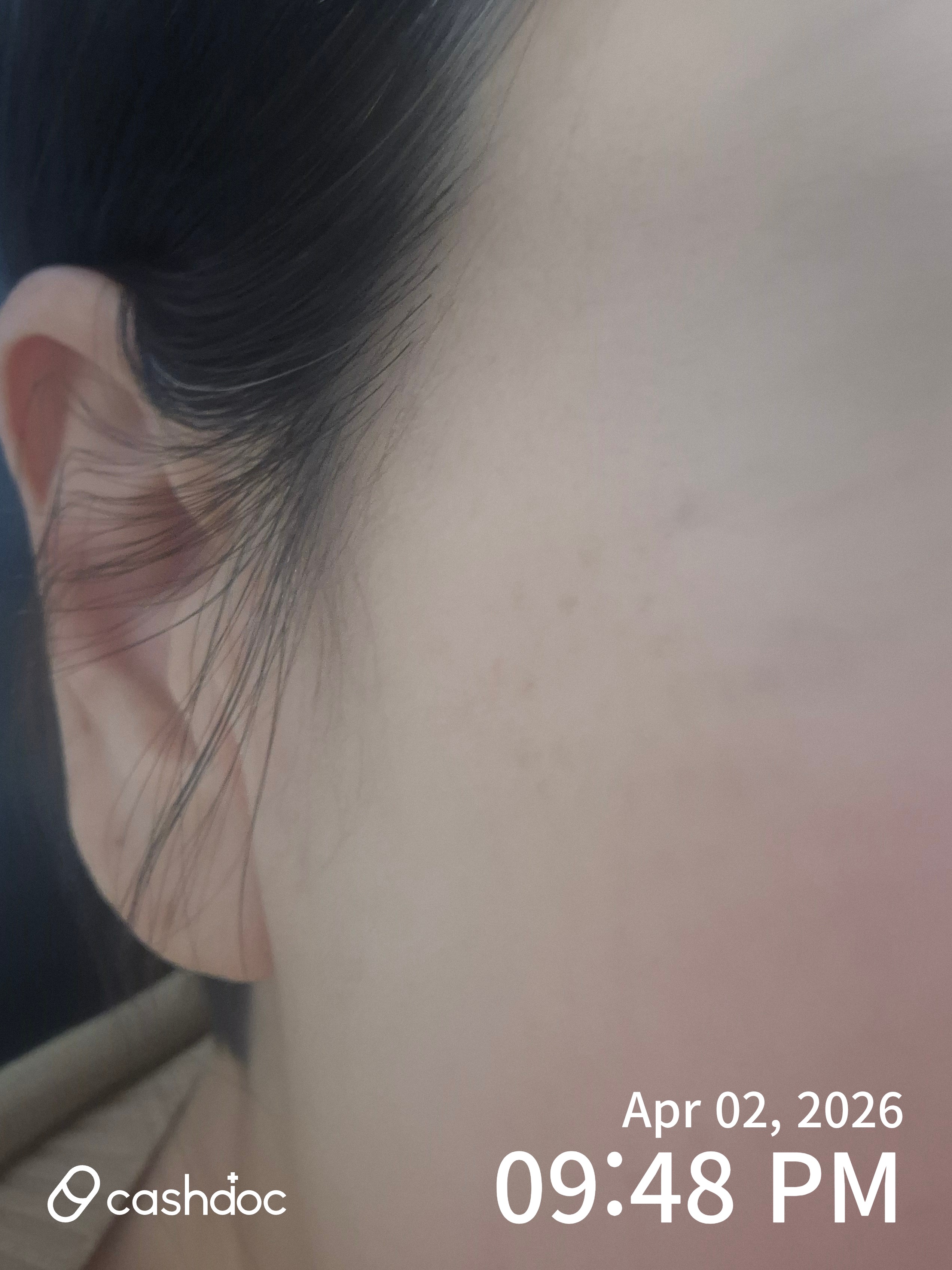 수원시 메이퓨어 광교점에서의 스킨부스터 시술 후기