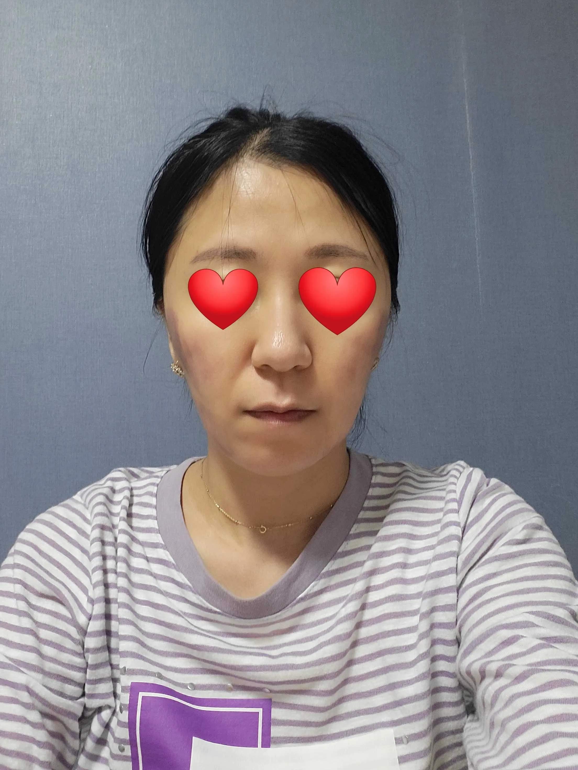 시술 후 — 미케이 인모드 포마_얼굴탄력,브이라인