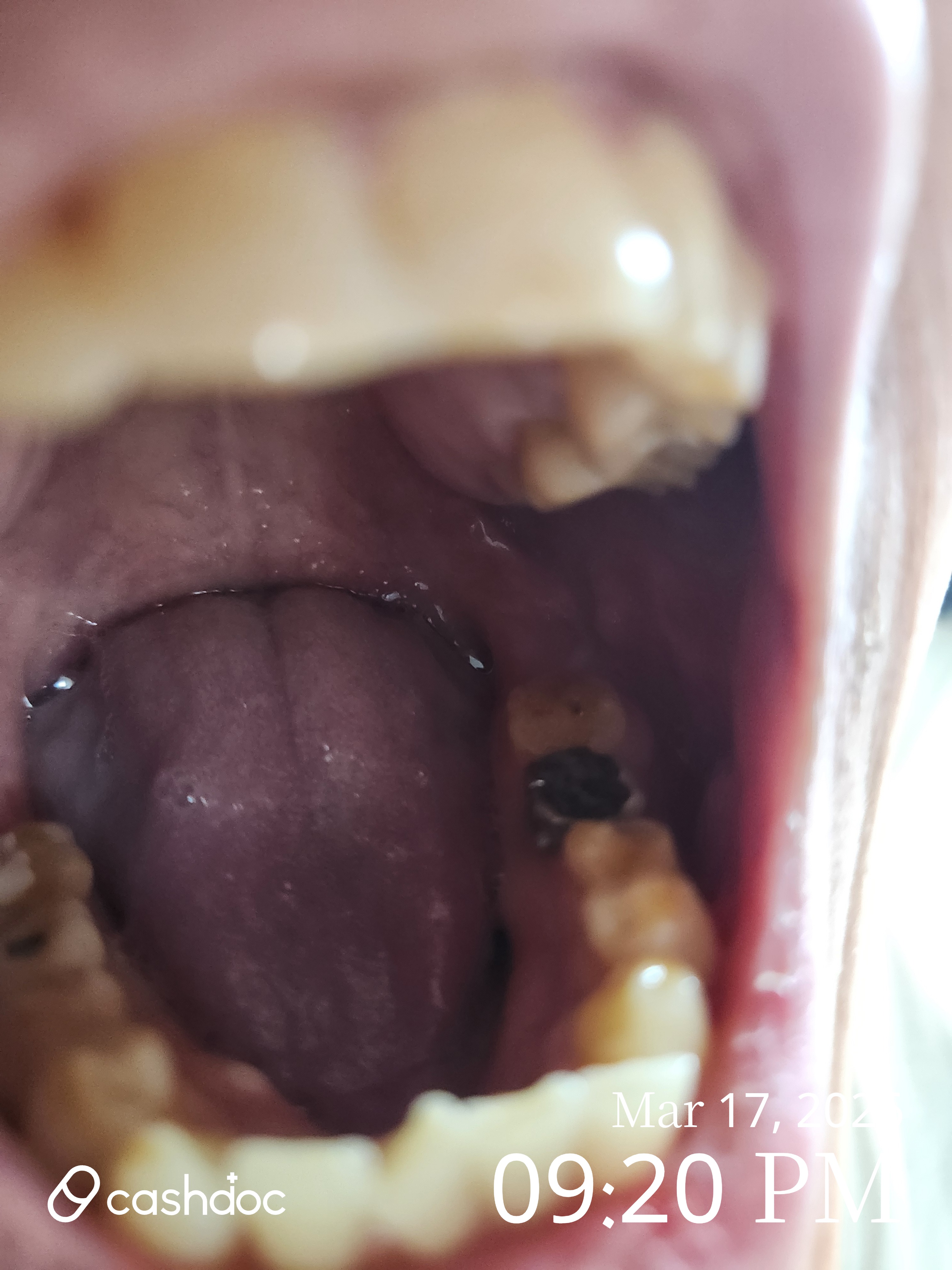 평택시 365래온치과에서 간편하게 사랑니 발치한 후기