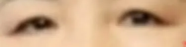 시술 전 — 눈성형~ 또렷하게 예쁜눈 