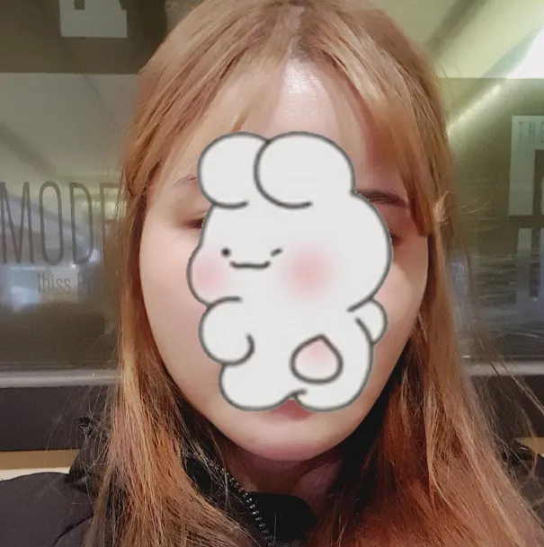 Before treatment — Wonjin_Facial Contouring