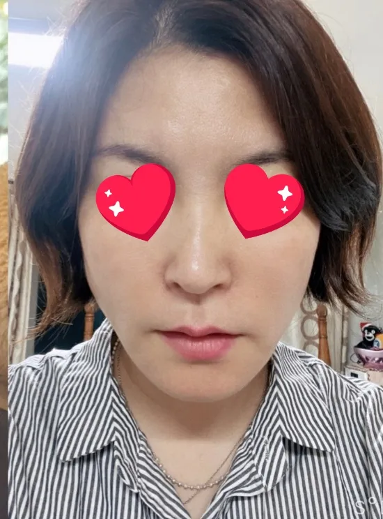 시술 후 — 실리프팅+필러 💙꿈프팅💙 29만원