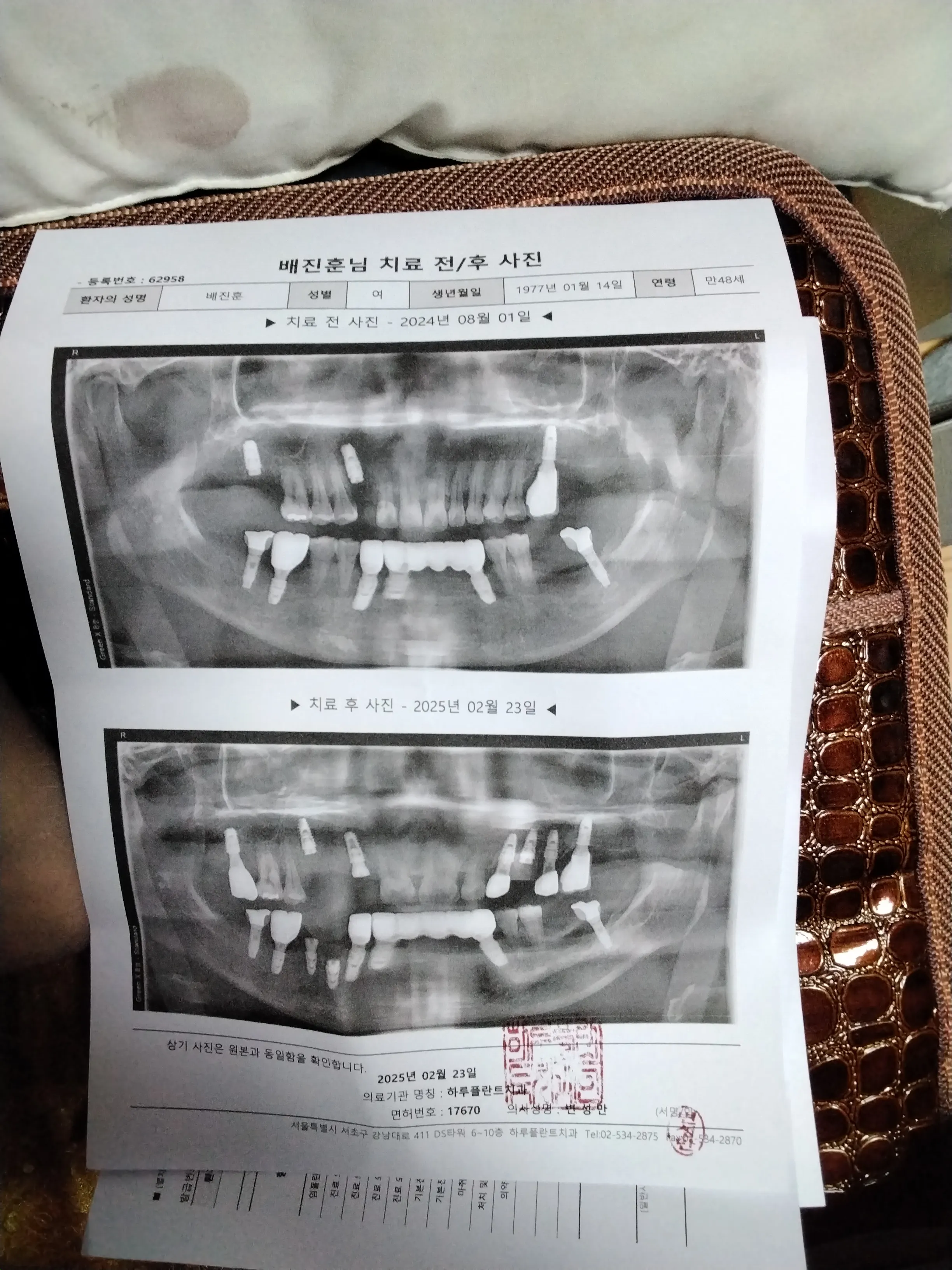 项目前 — 种植体每个280,000韩元 / 总共280万韩元