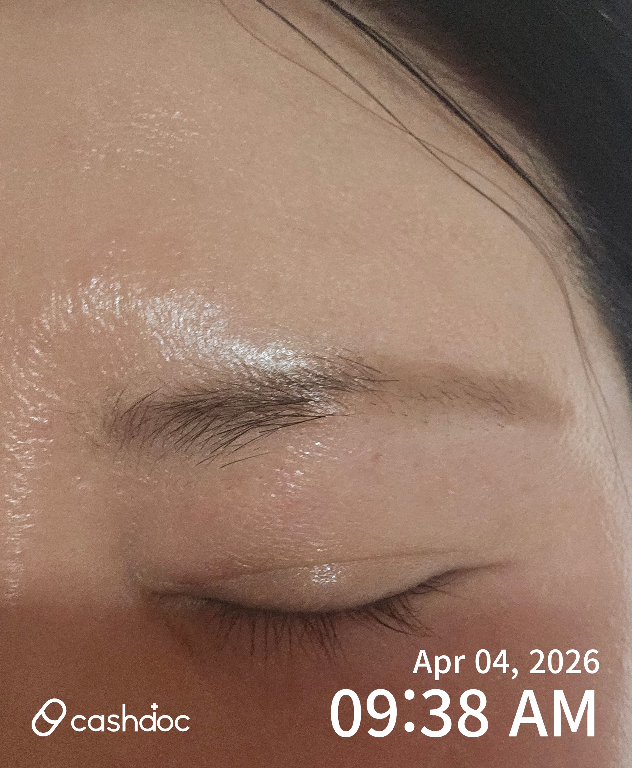 천안시 오리진성형외과의원에서 눈 재수술, 만족스러워요