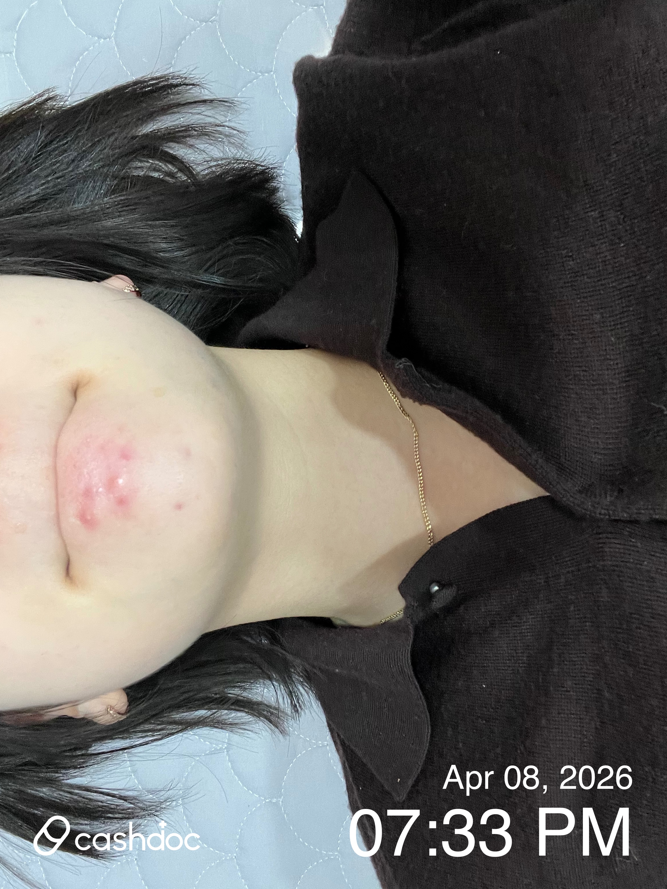 안양시 뮤즈의원, 화농성 여드름 염증주사 후 만족도 높아요