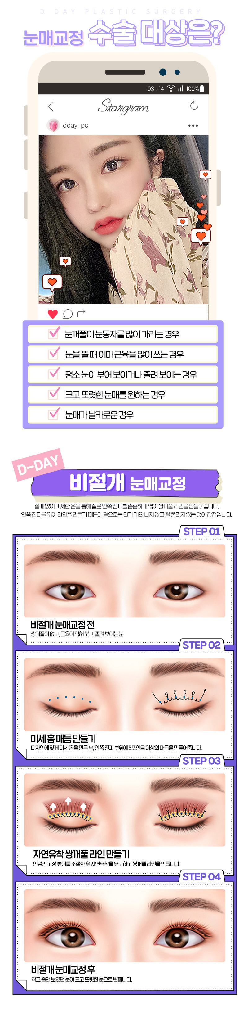디데이성형외과의원 디데이💖비절개눈매교정 이벤트, 시술 상세 이미지