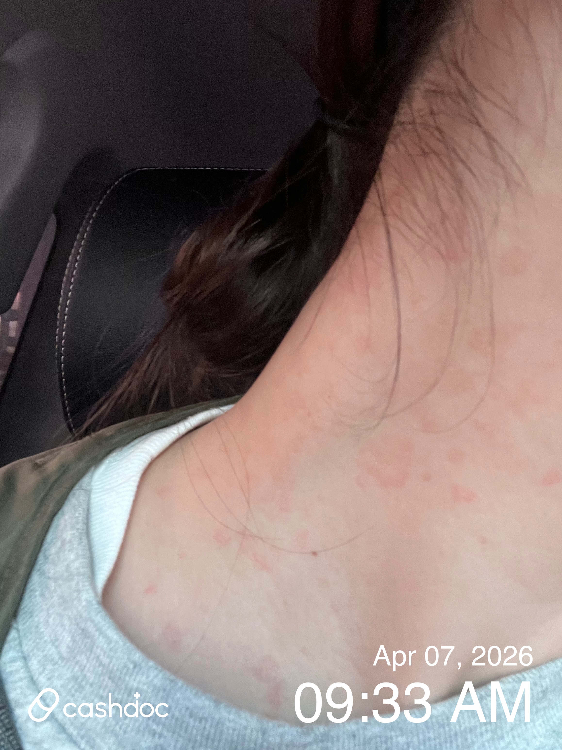 주말에 광주시 마이클래식피부과 방문, 진료 만족도 높아