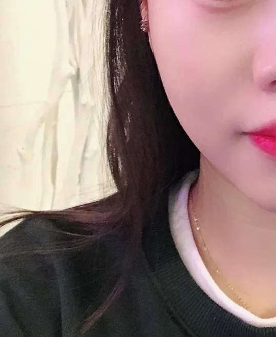 시술 전 — 싸이토케어 (에르메스주사)