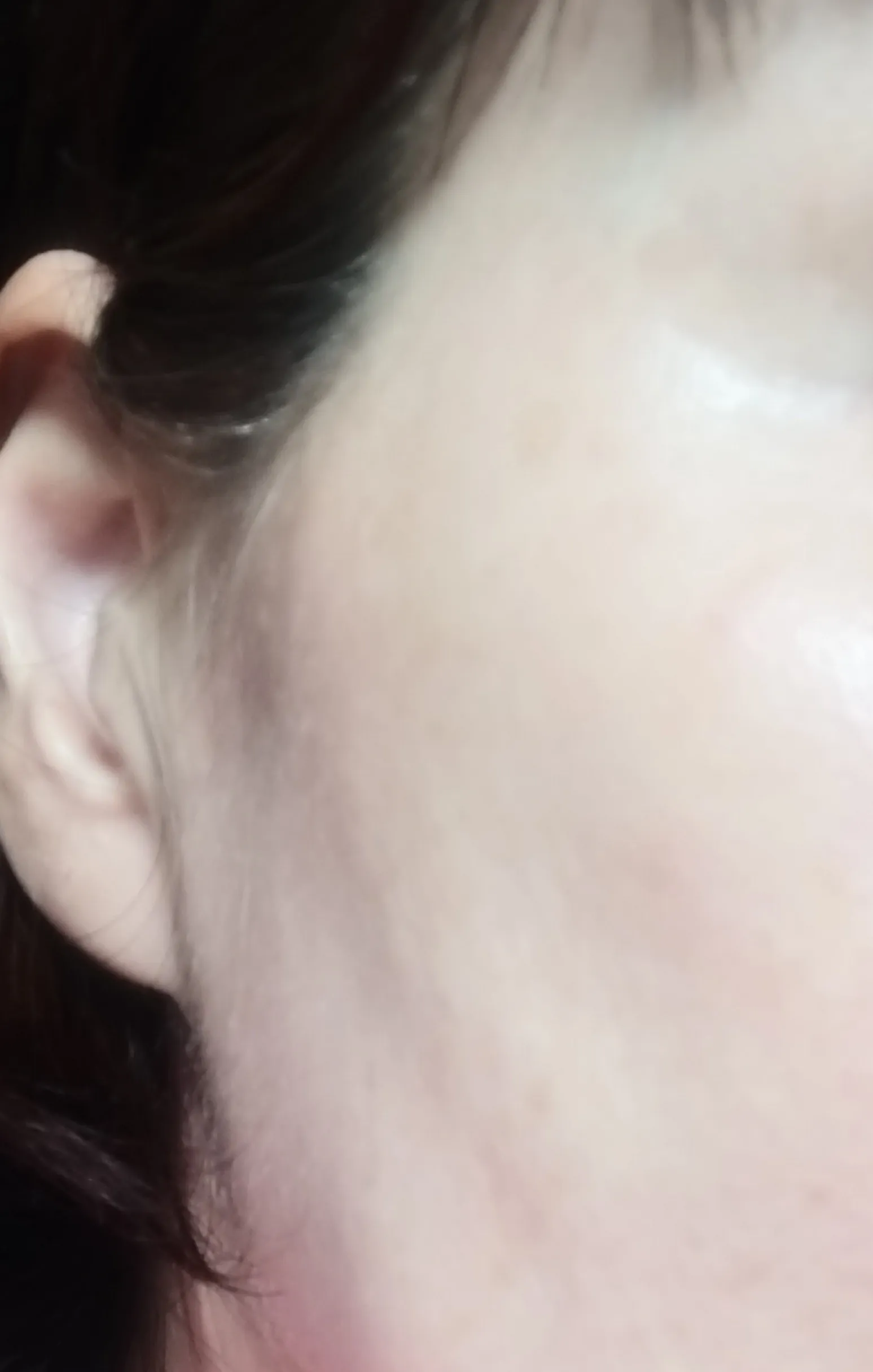After treatment — Awesome Rejuran Authentic