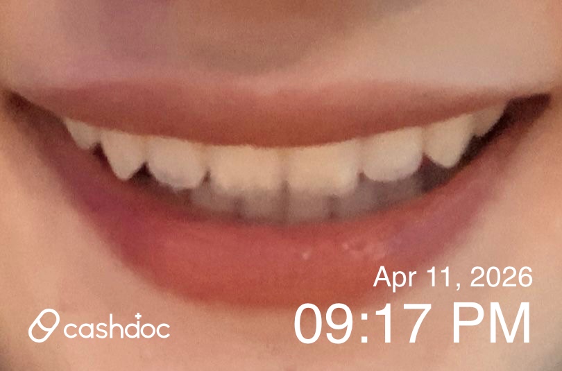 안동시 스마일라인치과의원, 교정 결과 너무 만족해요!