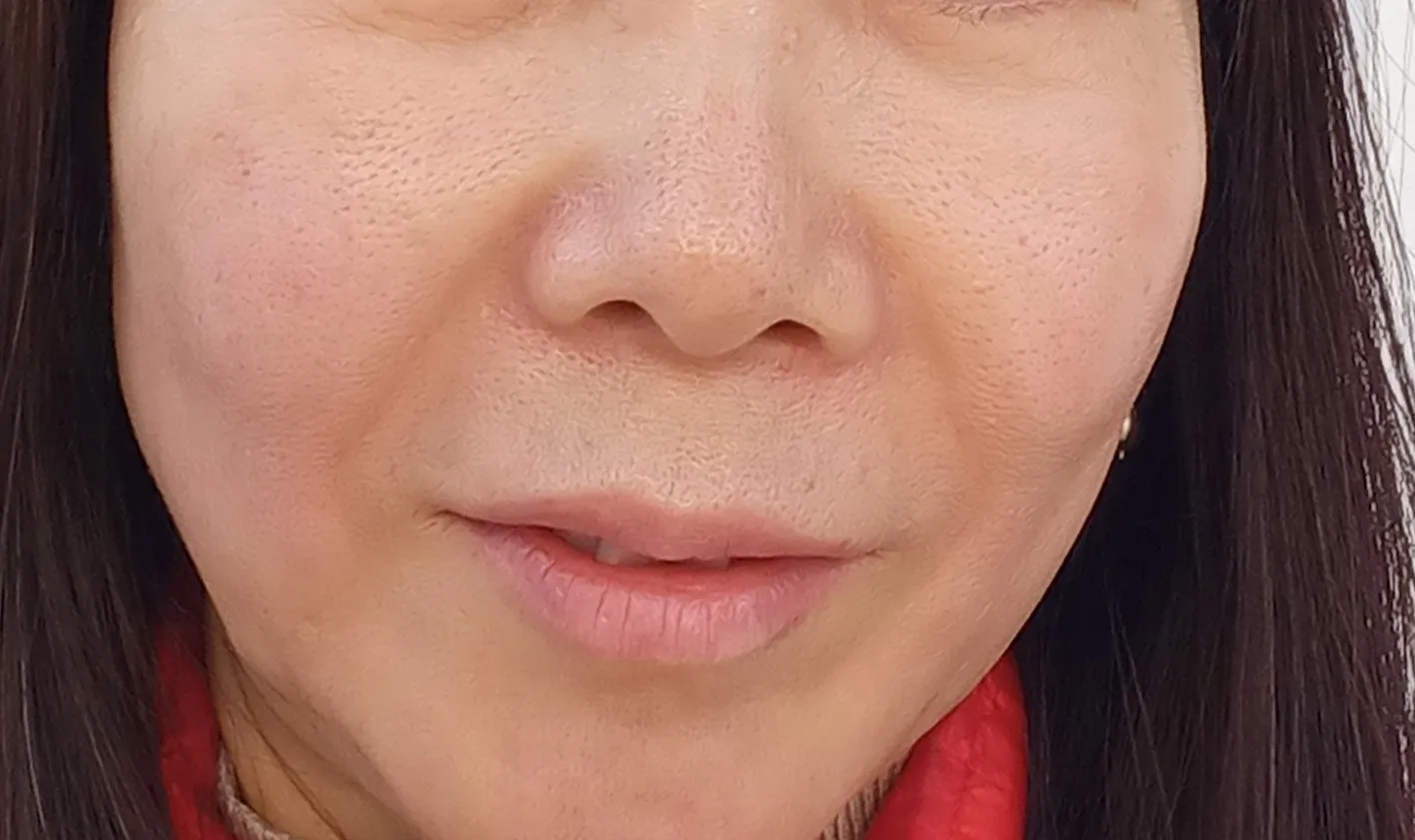 시술 후 — 미케이 피부 탄력개선_슈링크 300샷