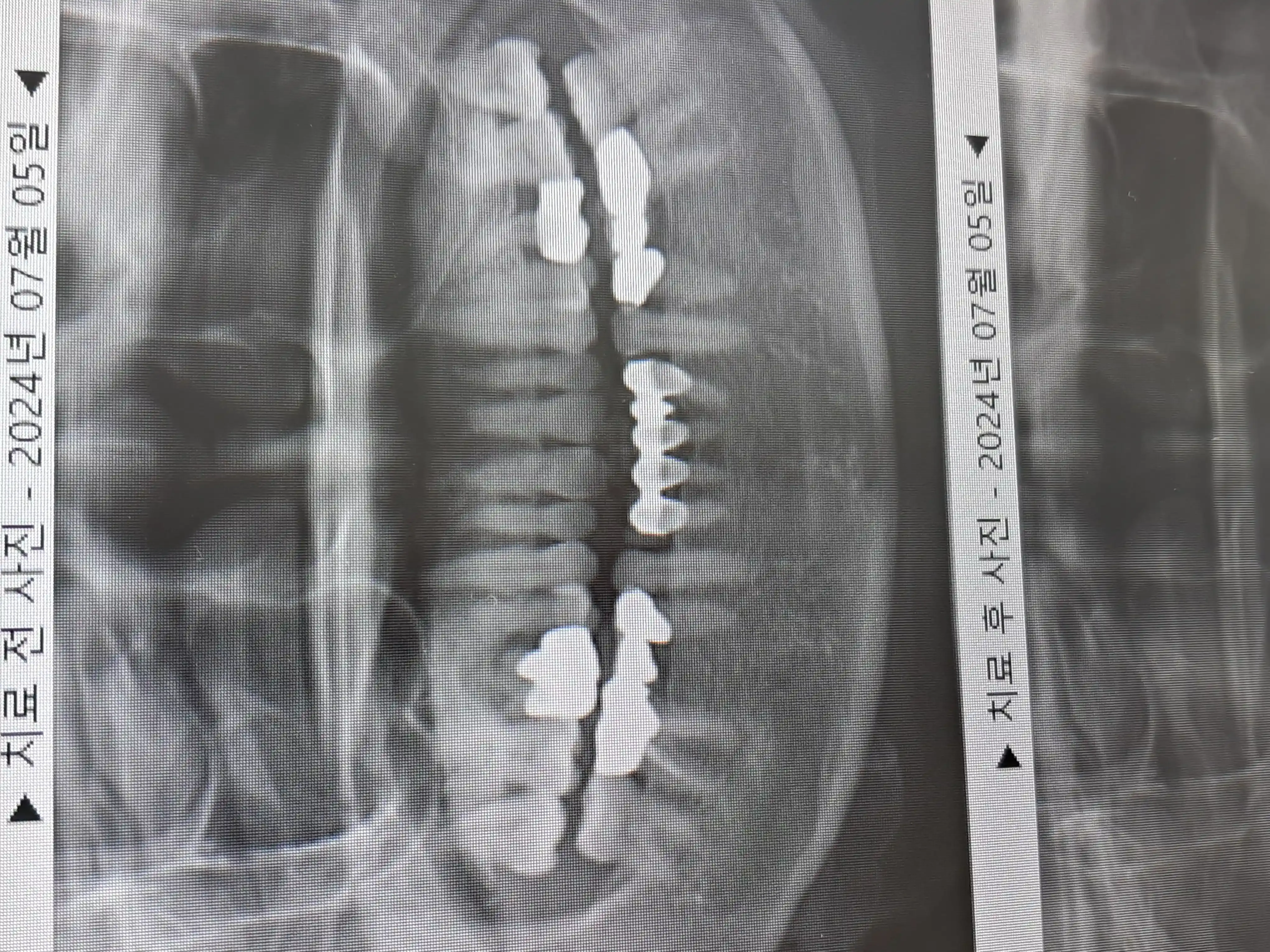 项目前 — 当天植入牙 Implant
